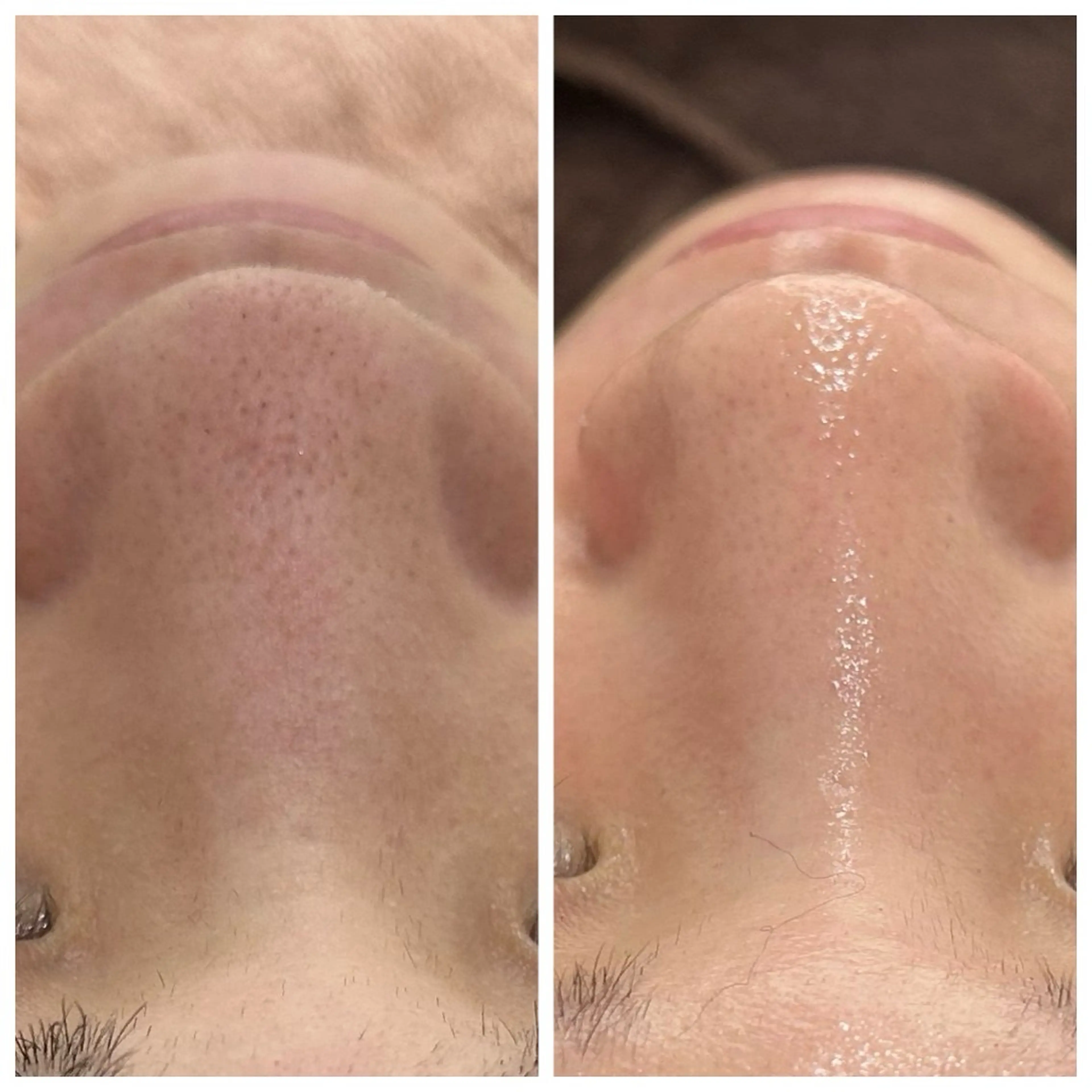 【毛穴洗浄】毛穴ごっそりお掃除コースの写真