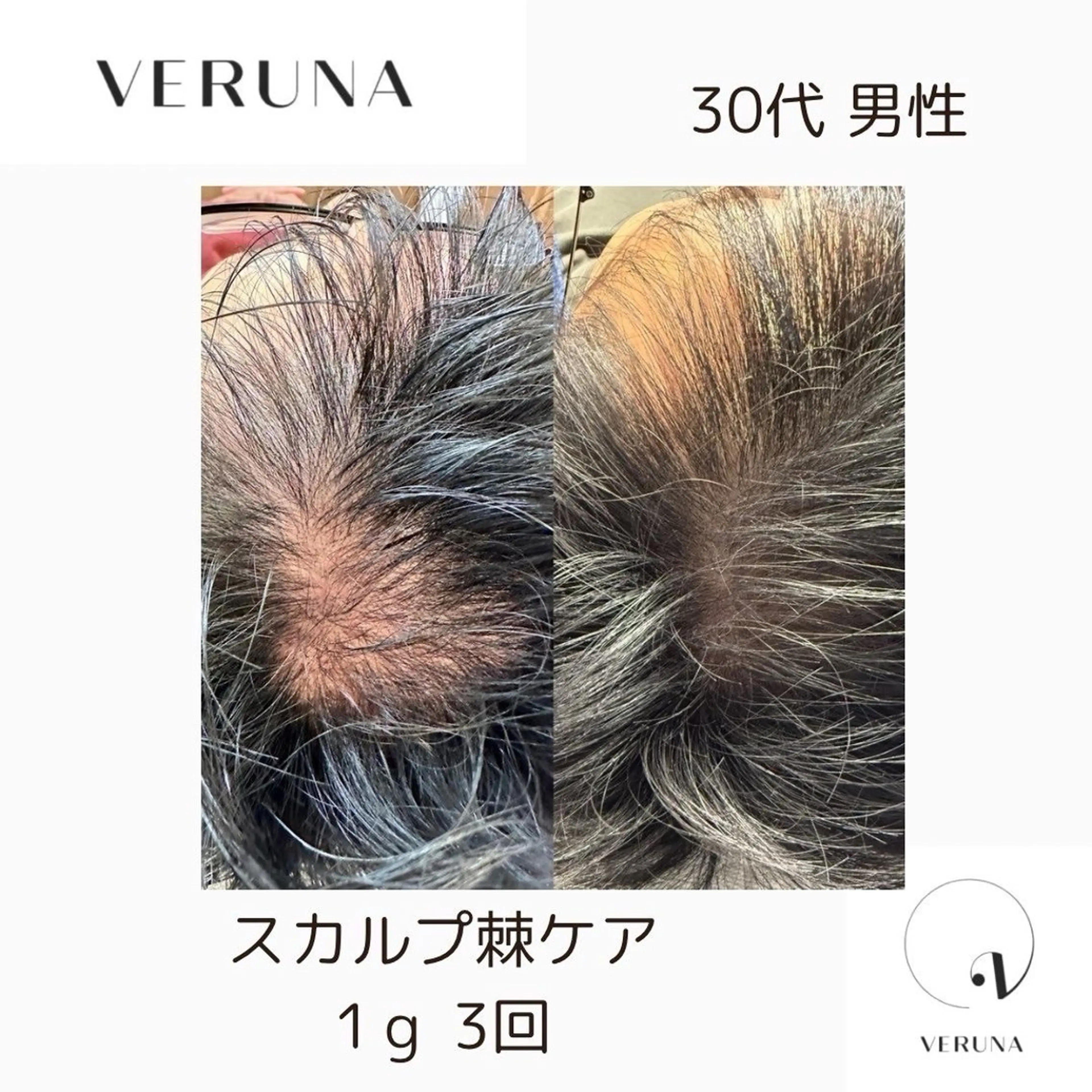 【薄毛】【円形脱毛】【分け目】スカルプトゲケア！毛根に栄養をたっぷり与えて、毛根生き生きと蘇らせる！再生ケアの写真
