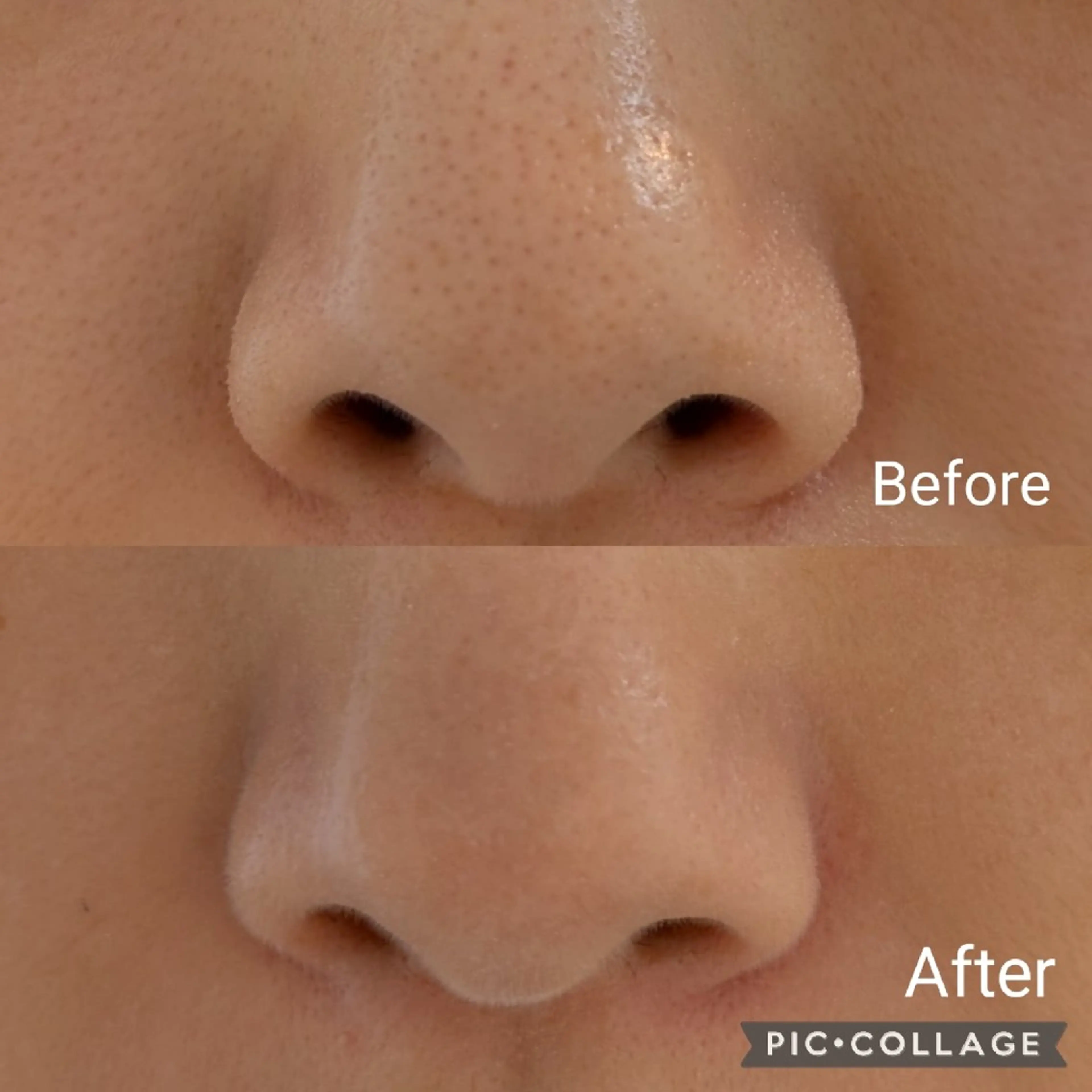 エステ 毛穴フェイシャルエステkokotto板橋所属・板橋美肌ハーブ ピーリング1位のエステ・リラクイメージ