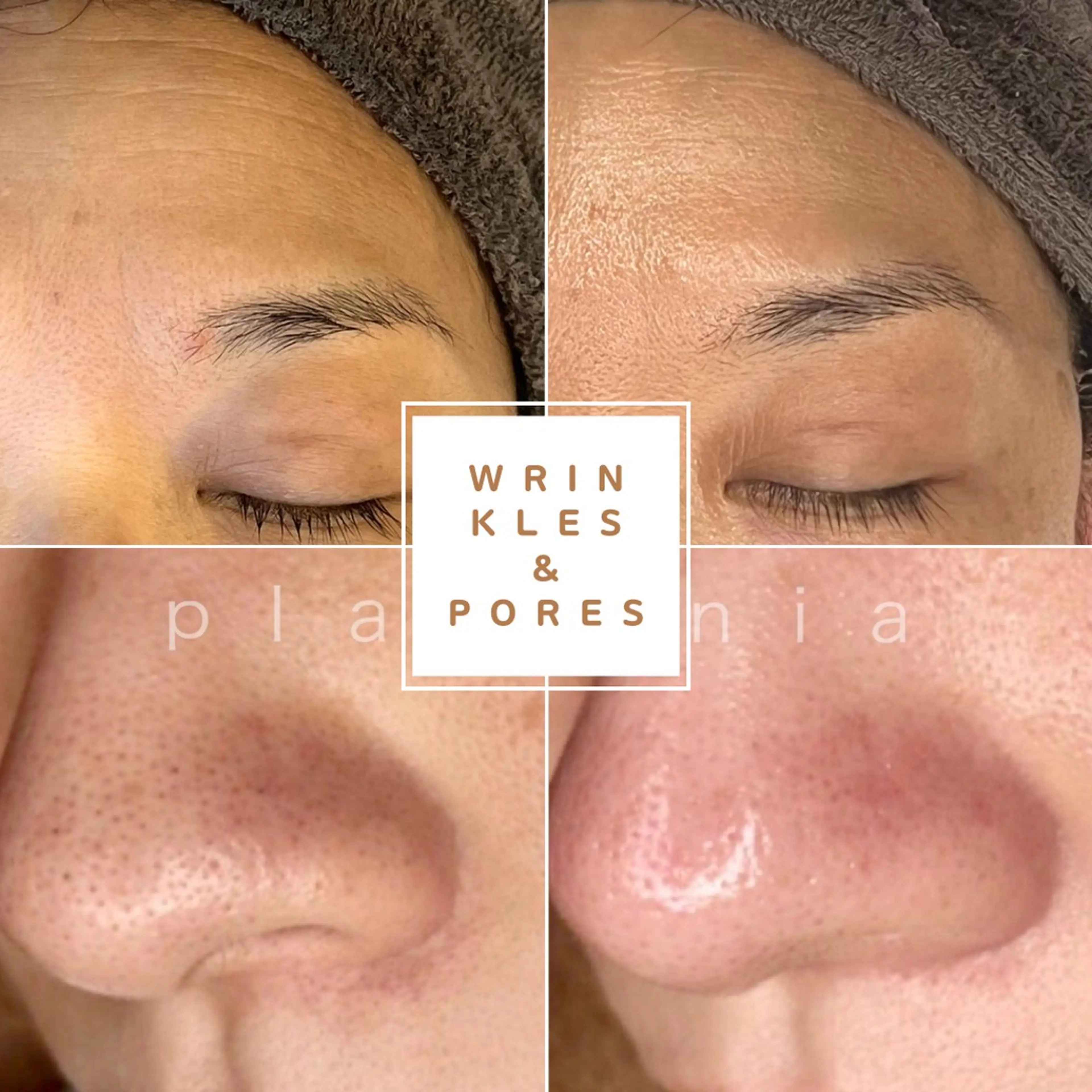 【平日予約限定価格】毛穴・小ジワ改善！プラズマ照射・美容液導入で肌再生力UP×ドライヘッドマッサージで頭皮から引き上げ♪の写真