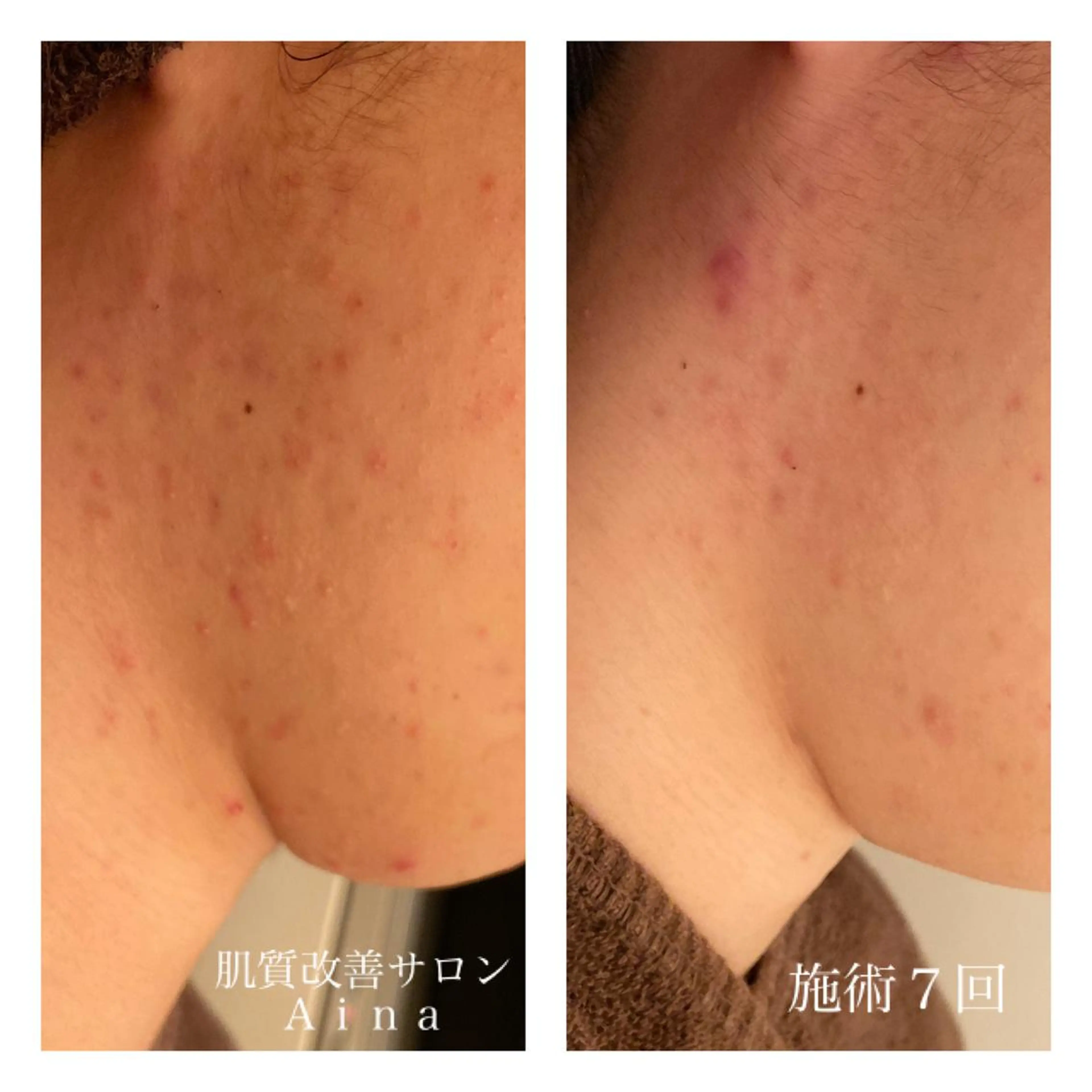 ロング カラー パーマ ヘアアレンジ メンズ キッズ ネイル マツエク・マツパ 卒業式のヘアスタイル 桜ネイル 卒業式 ニキビ跡専門サロン Ainaのエステ・リラクイメージ