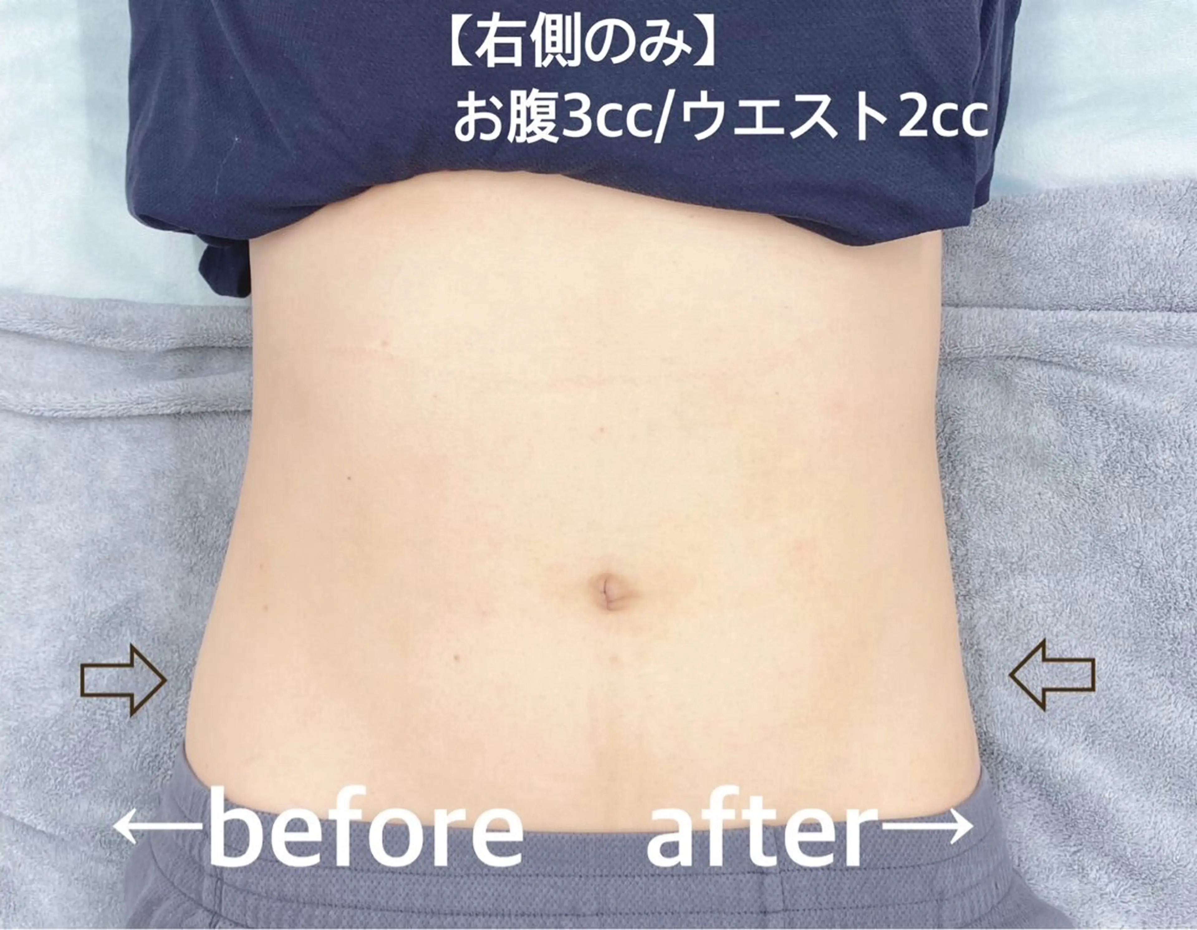 【１２０分】韓国発レモン🍋お顔+ボディOK🍋１０ccボトルの写真