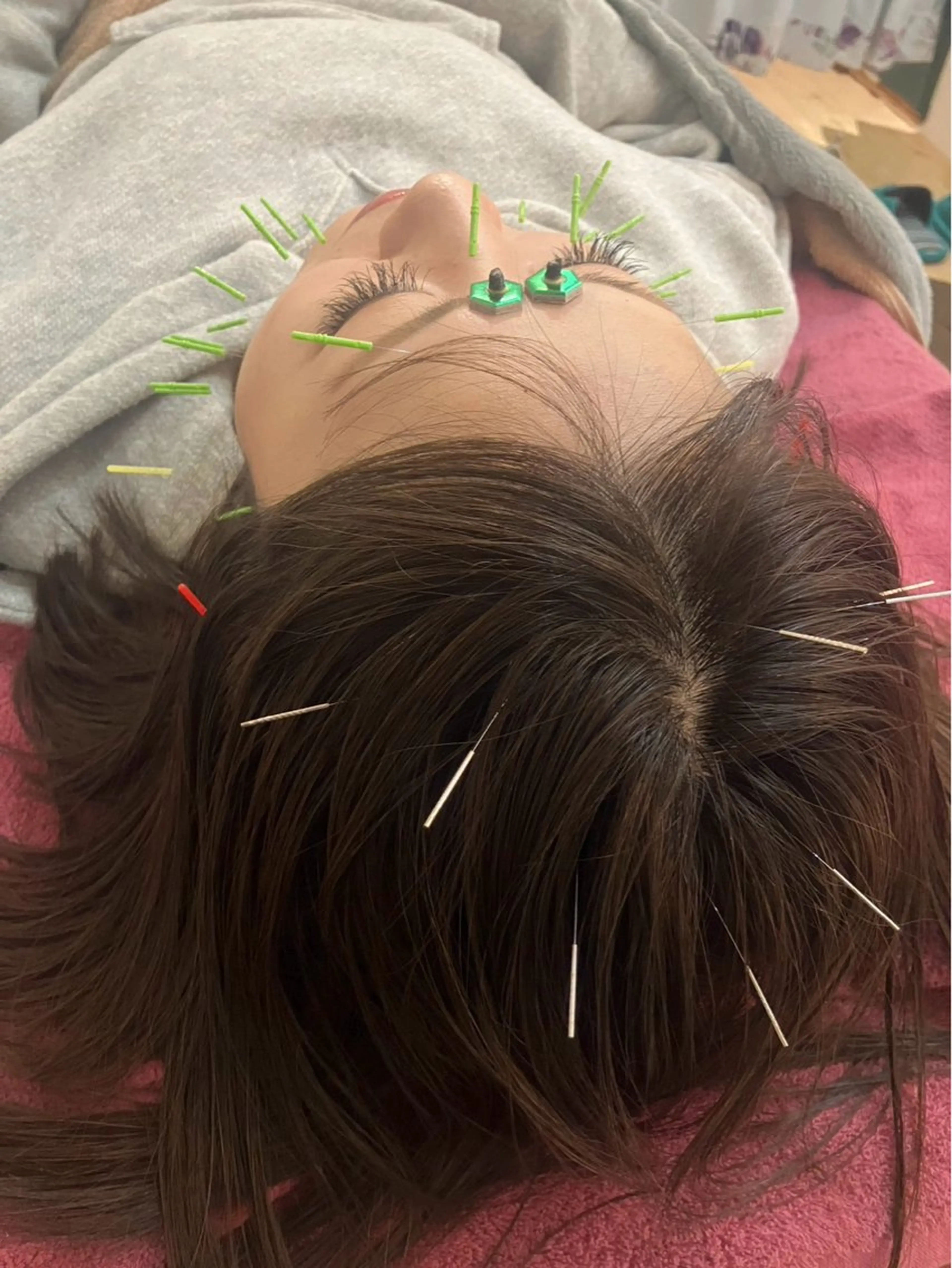 ミニモ学割🧑‍🎓痛くない小顔美容鍼✨初めての方にもオススメ※メイクされたままでもOK☆の写真