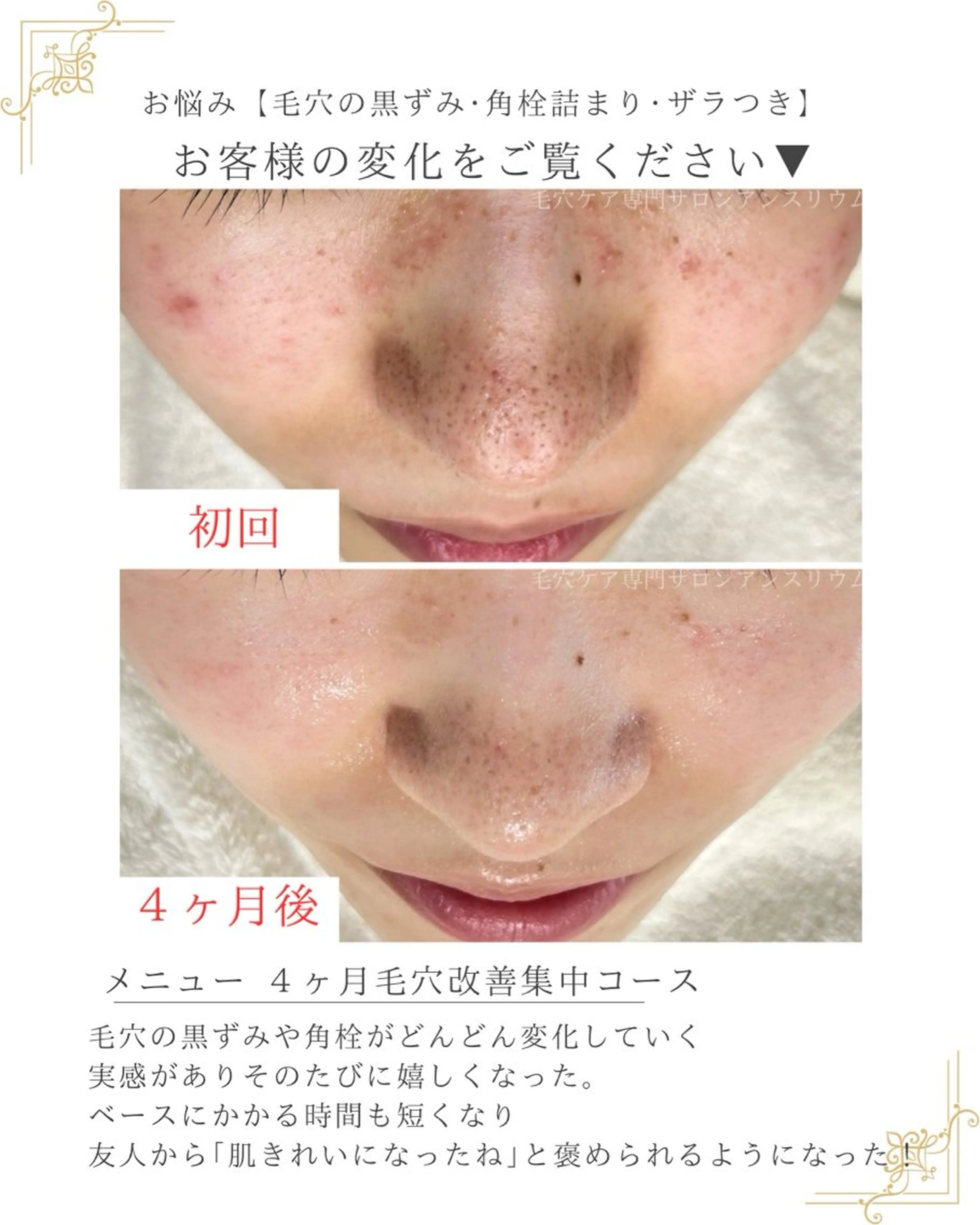 毛穴ケア専門サロンアンスリウム所属・茨城土浦 つくば毛穴 ケア専門サロンのエステ・リラクイメージ