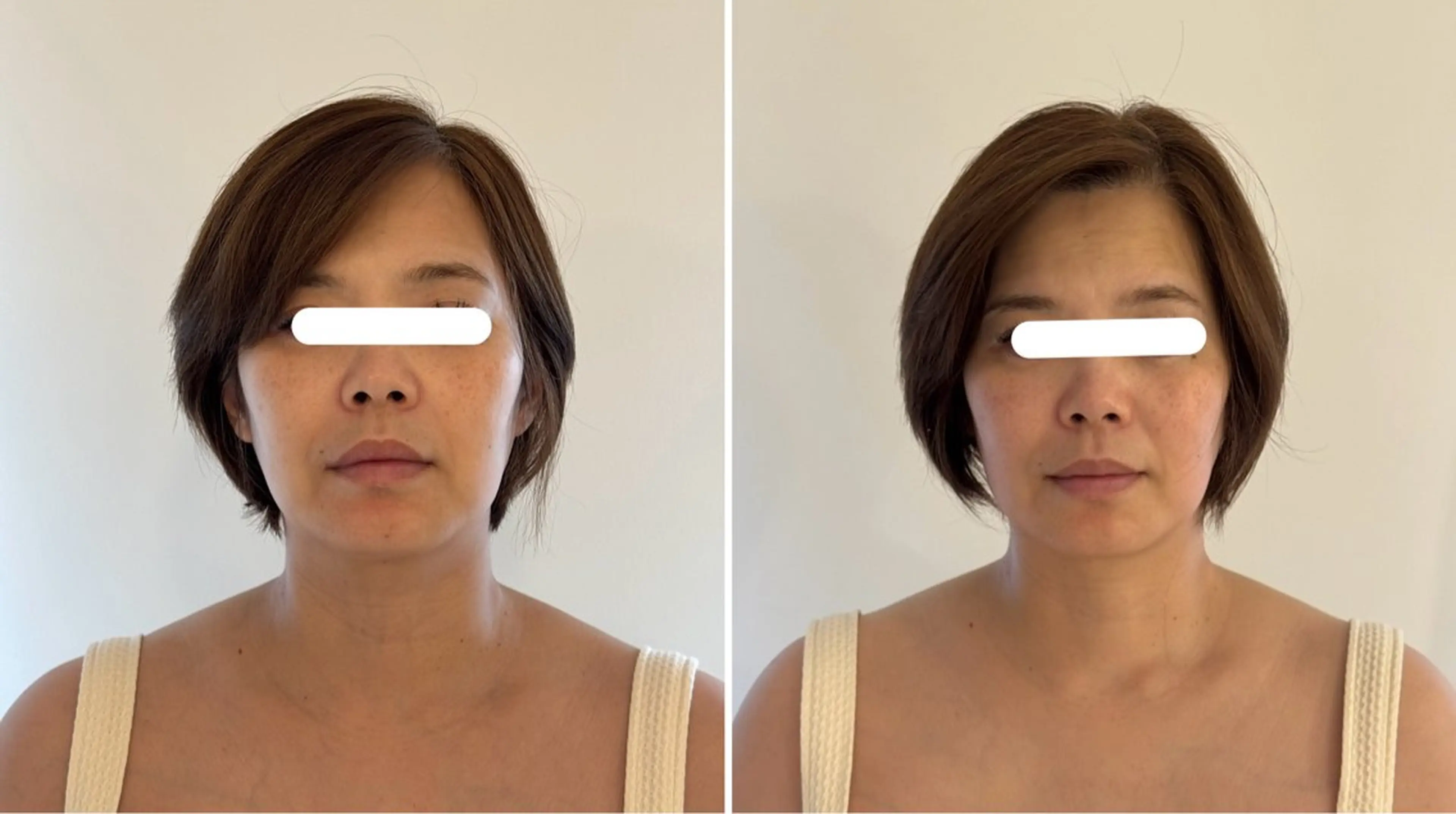 ハイパーナイフ小顔コルギ60分の写真