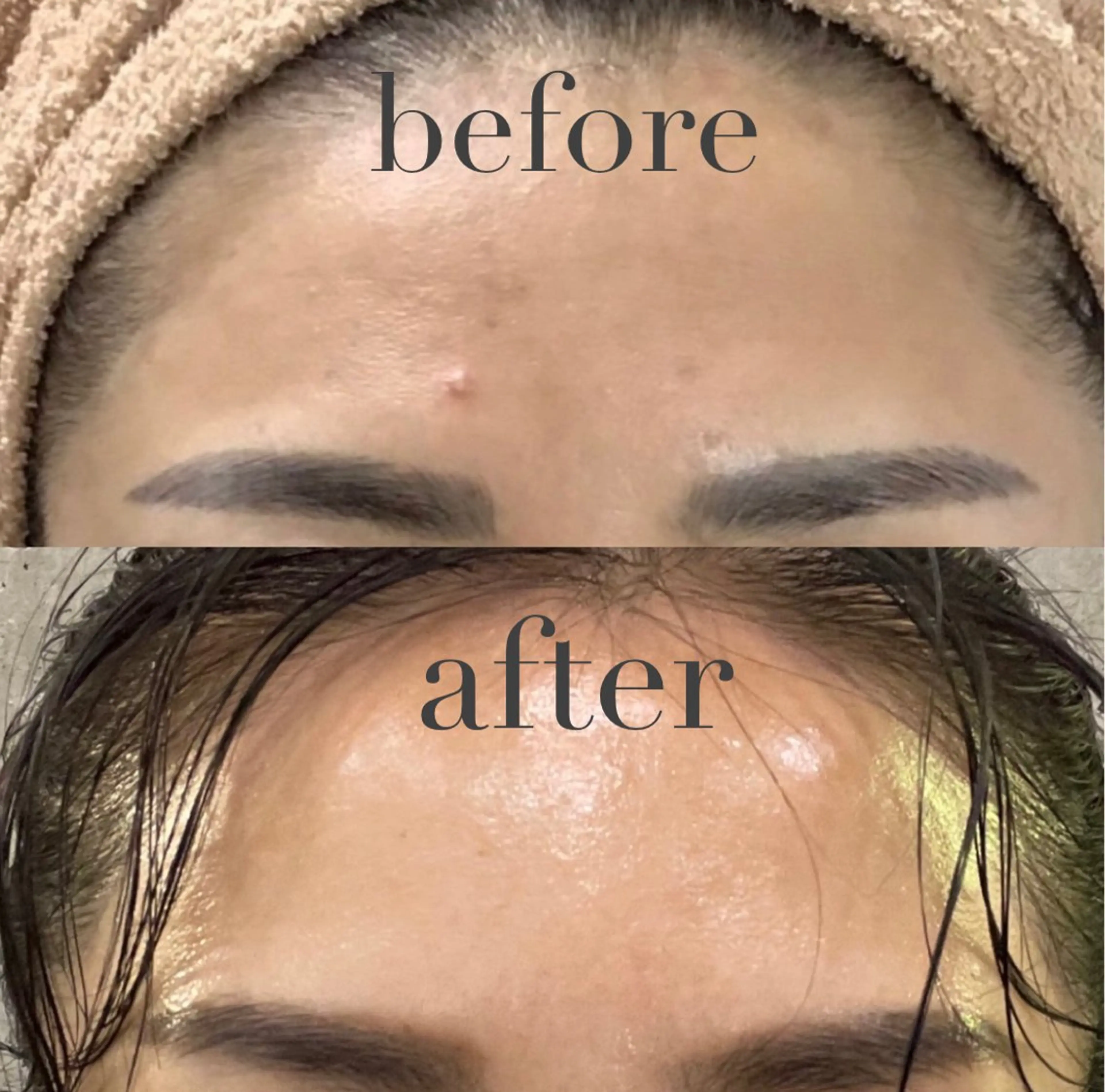 🉐お肌ピカピカコース→酵素洗顔パック→乳酸ピーリング→幹細胞美容液導入→パック→コラーゲンマシーン→保湿→日焼け対策の写真