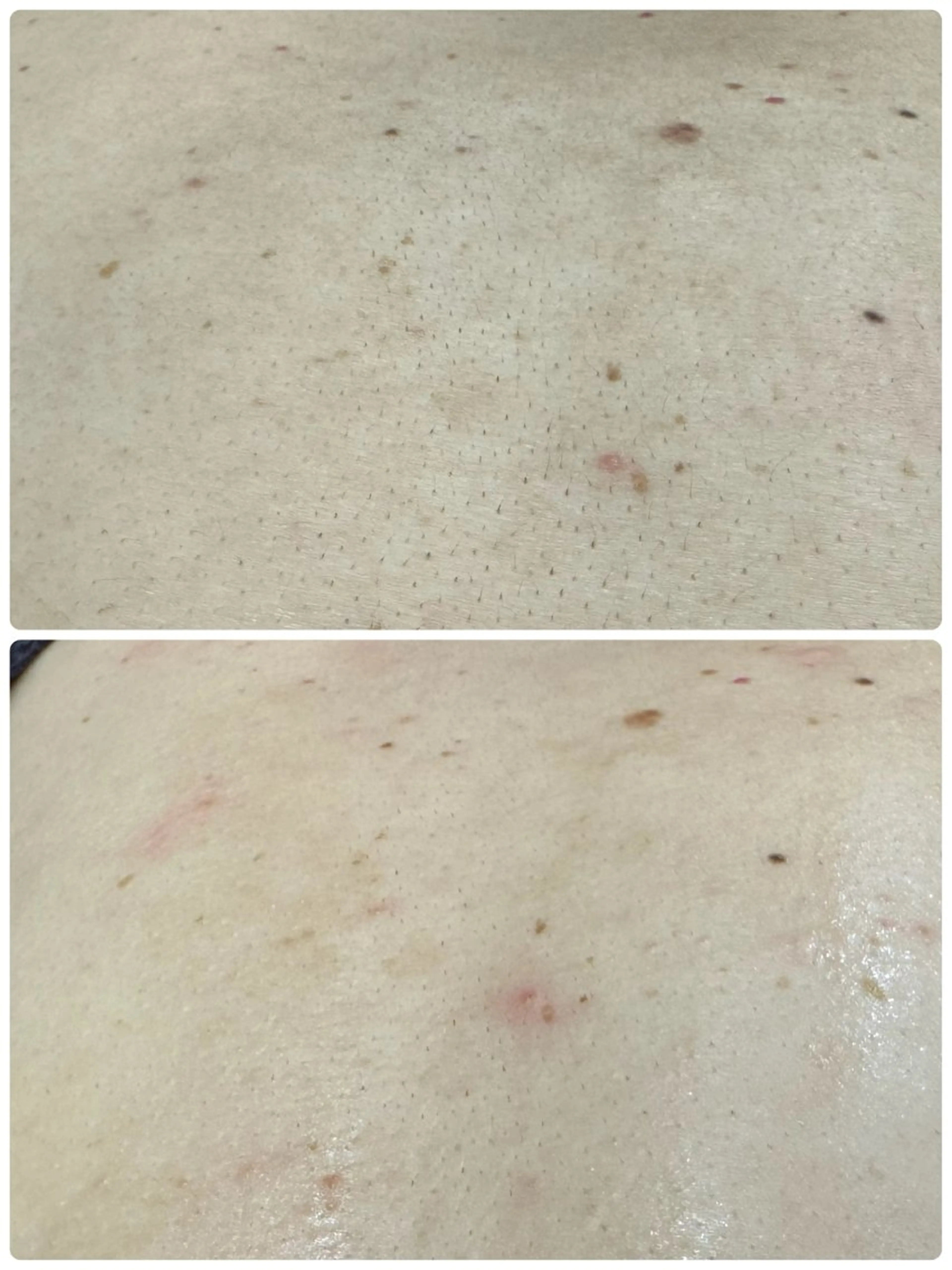 キッズ 脱毛 クラスペディア脱毛 ・フェイシャル専門店のエステ・リラクイメージ