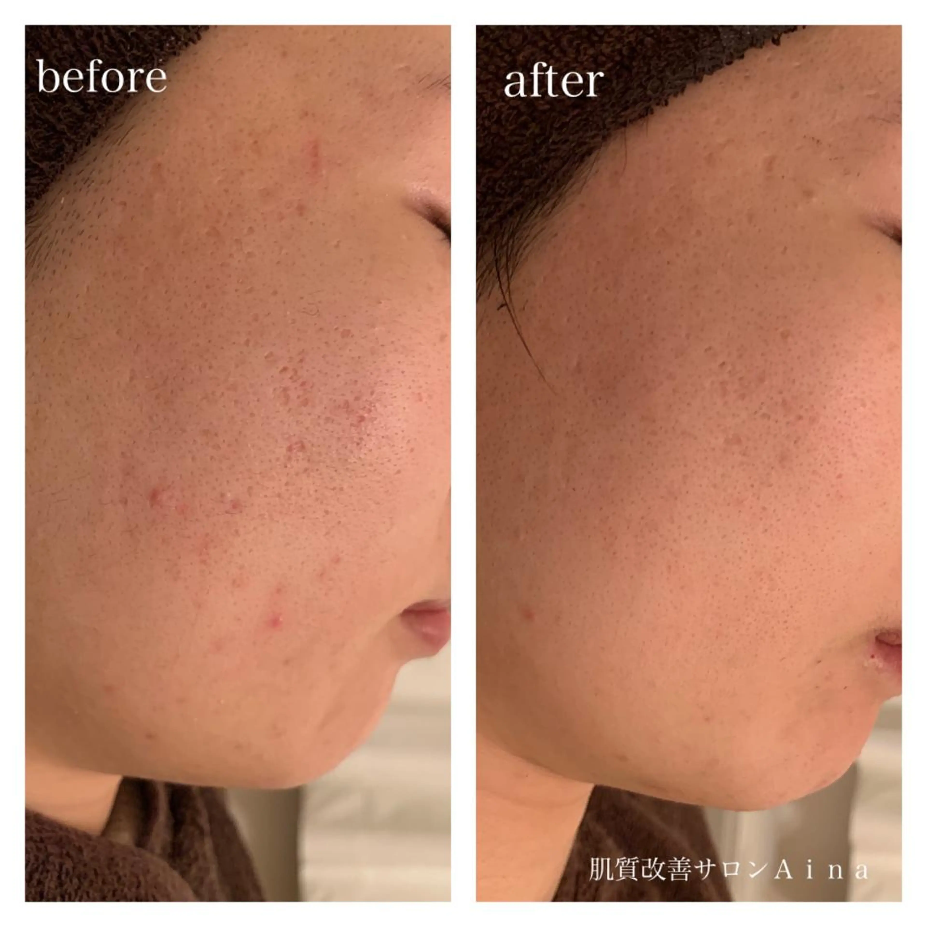 セミロング カラー パーマ ヘアアレンジ メンズ キッズ ネイル マツエク・マツパ 赤色 エステ リラク ニキビ跡専門サロン Ainaのエステ・リラクイメージ