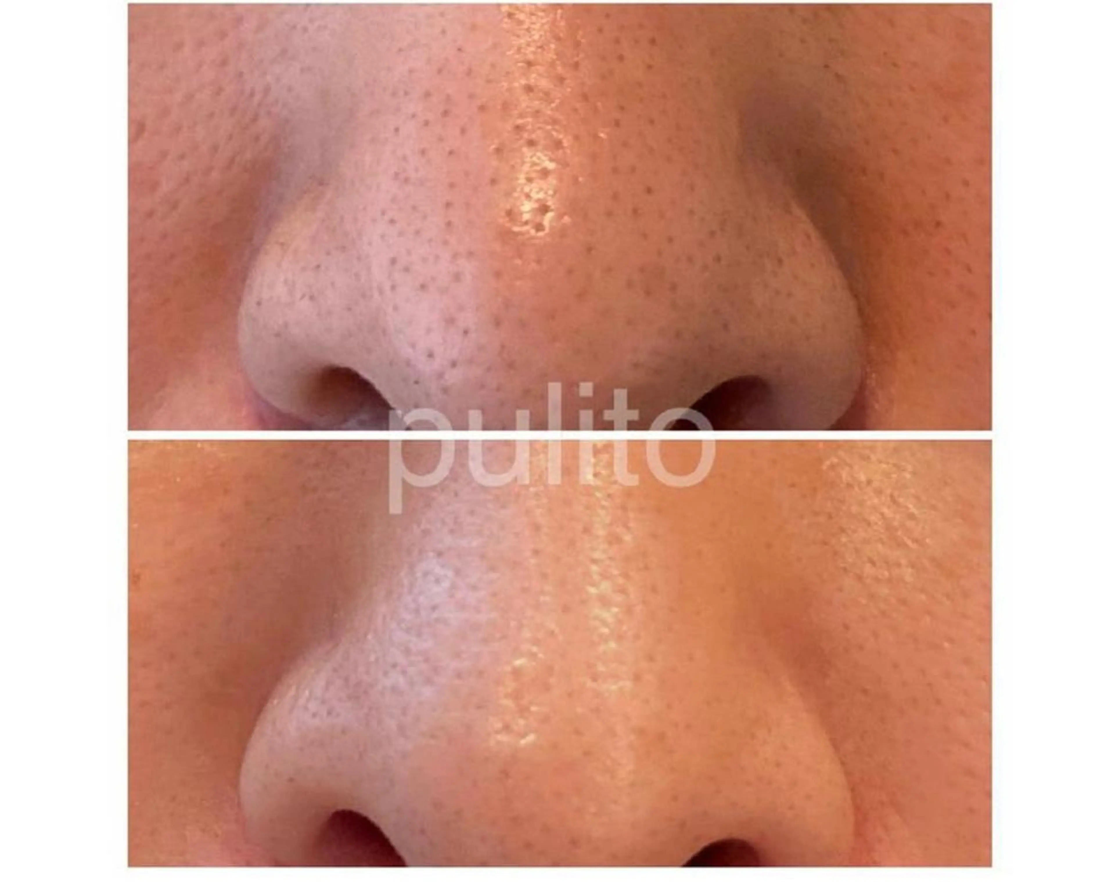 ハイドロスキンビタミン導入つき♪毛穴角栓の汚れとり！吹出物改善！くすみ改善！⁡ダウンタイムなしのピーリングでつるつるに！の写真