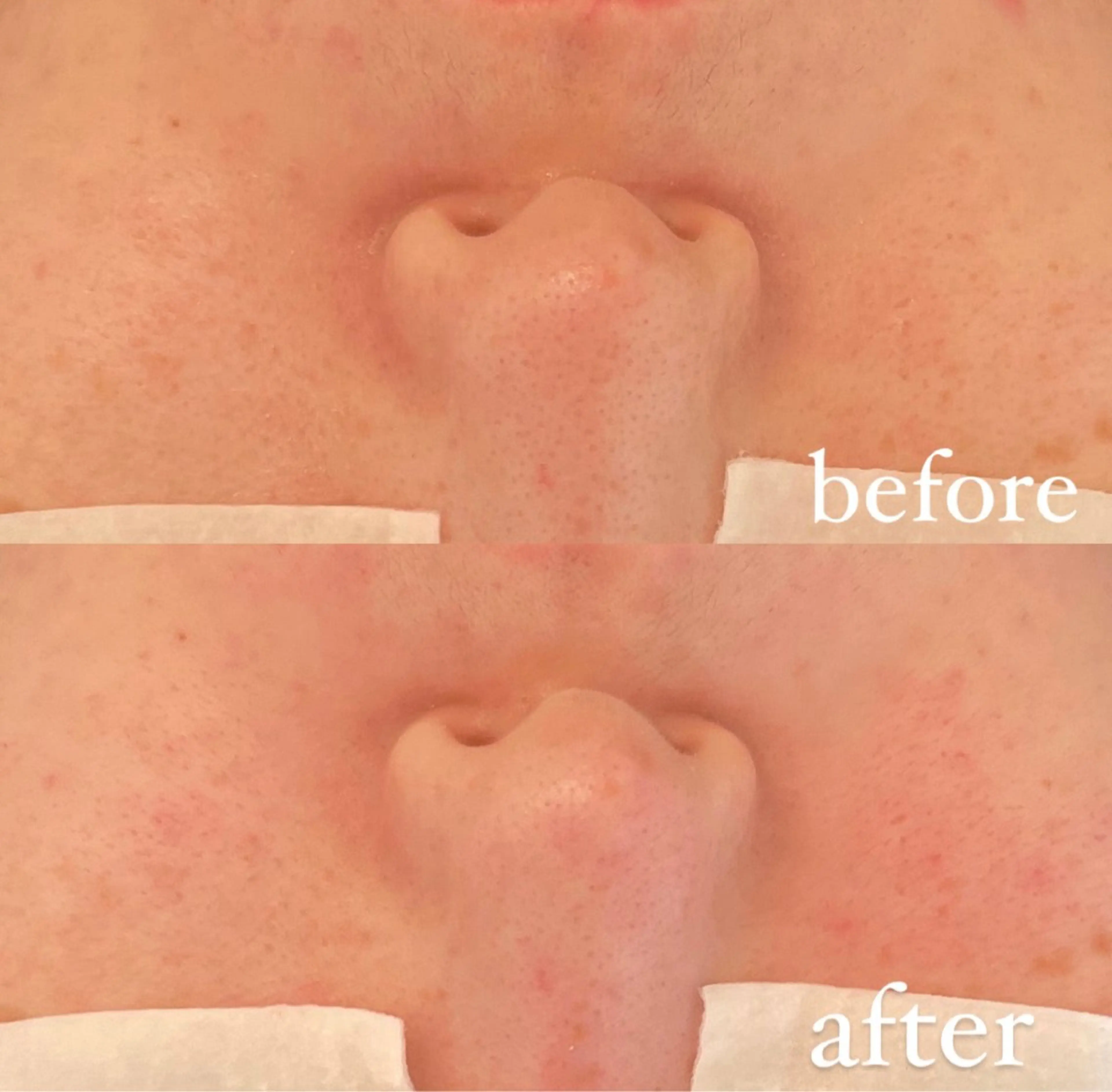 毛穴ケア/毛穴診断/ 毛穴洗浄〔心斎橋〕のエステ・リラクイメージ