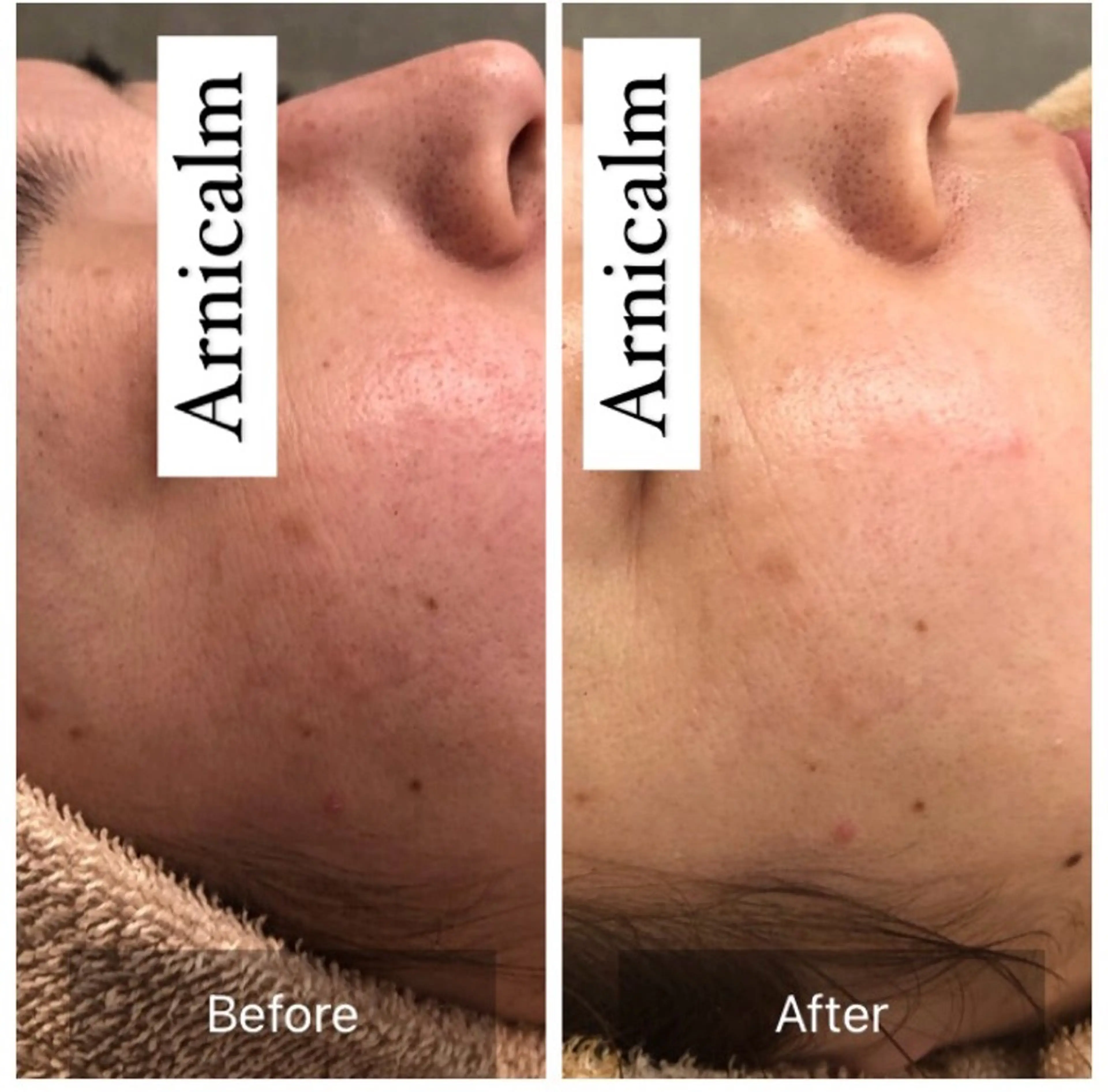 エステ ハーブピーリング 肌再生ピーリング/のエステ・リラクイメージ