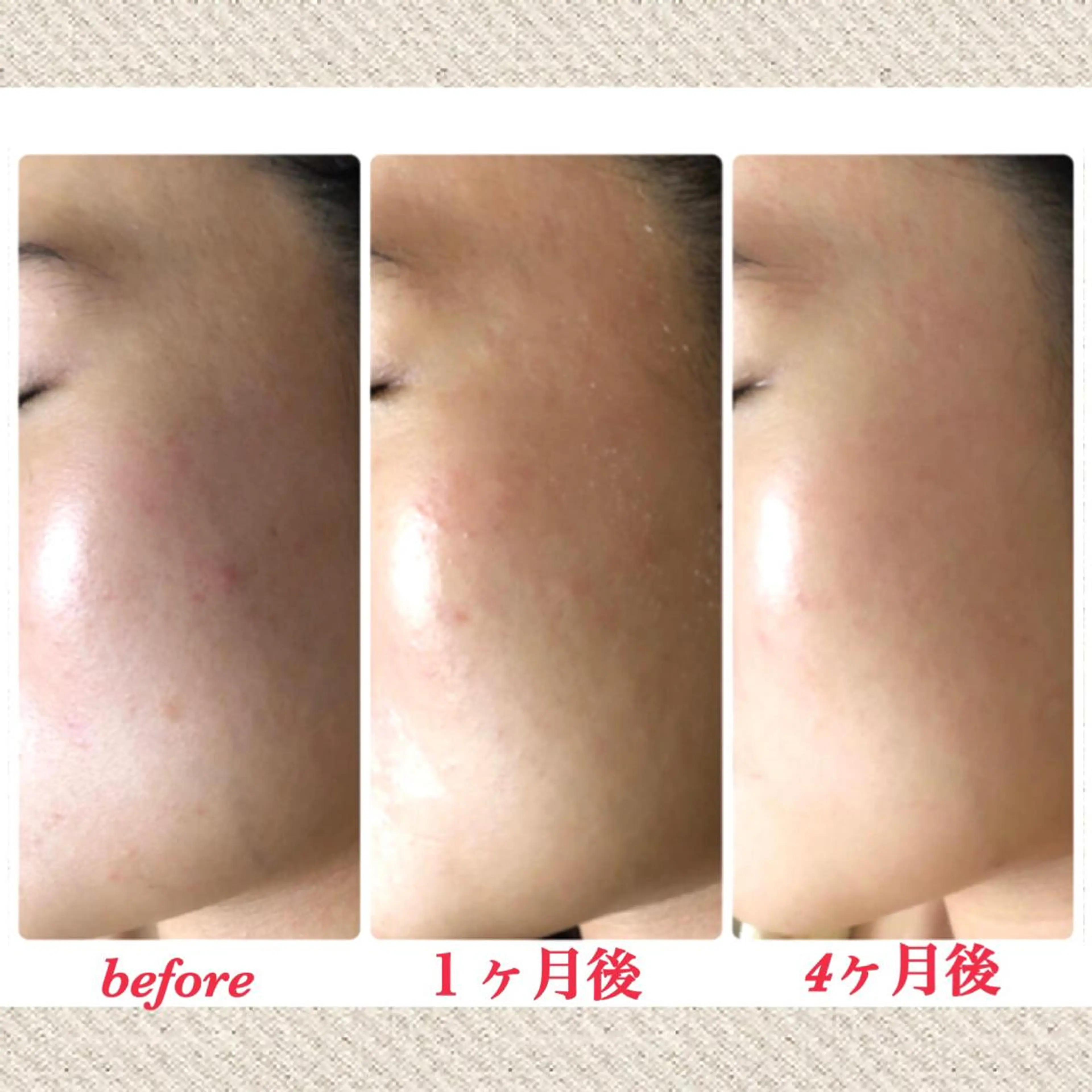 先進美容でも大人気❣️❣️純度100%ヒト幹細胞W導入フェイス✨医療グレードのヒト幹細胞培養上清液使用で肌質改善に💓の写真