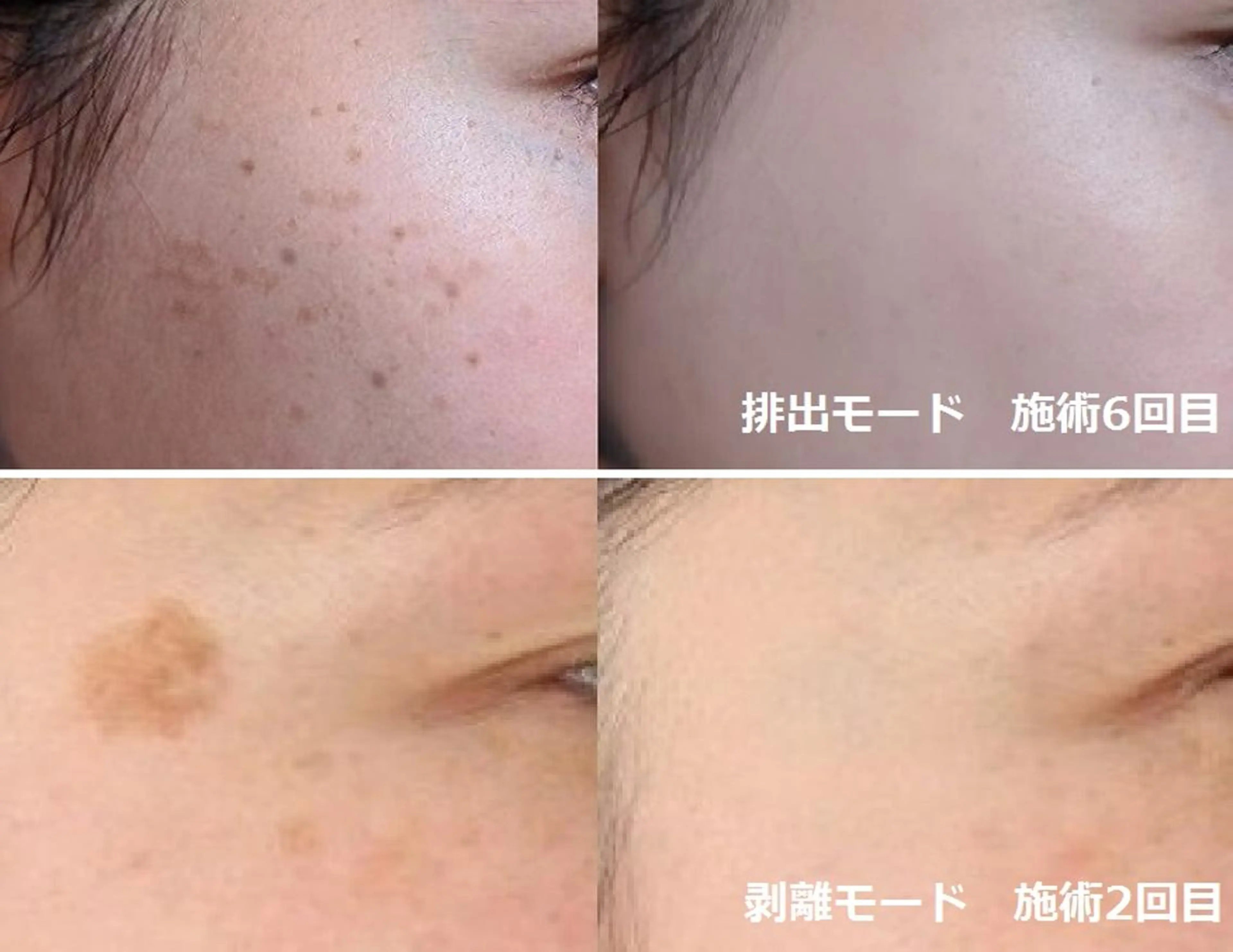 エステ 顔脱毛＆毛穴＆ニキビ 優良№1♪ヒロコ♪のエステ・リラクイメージ