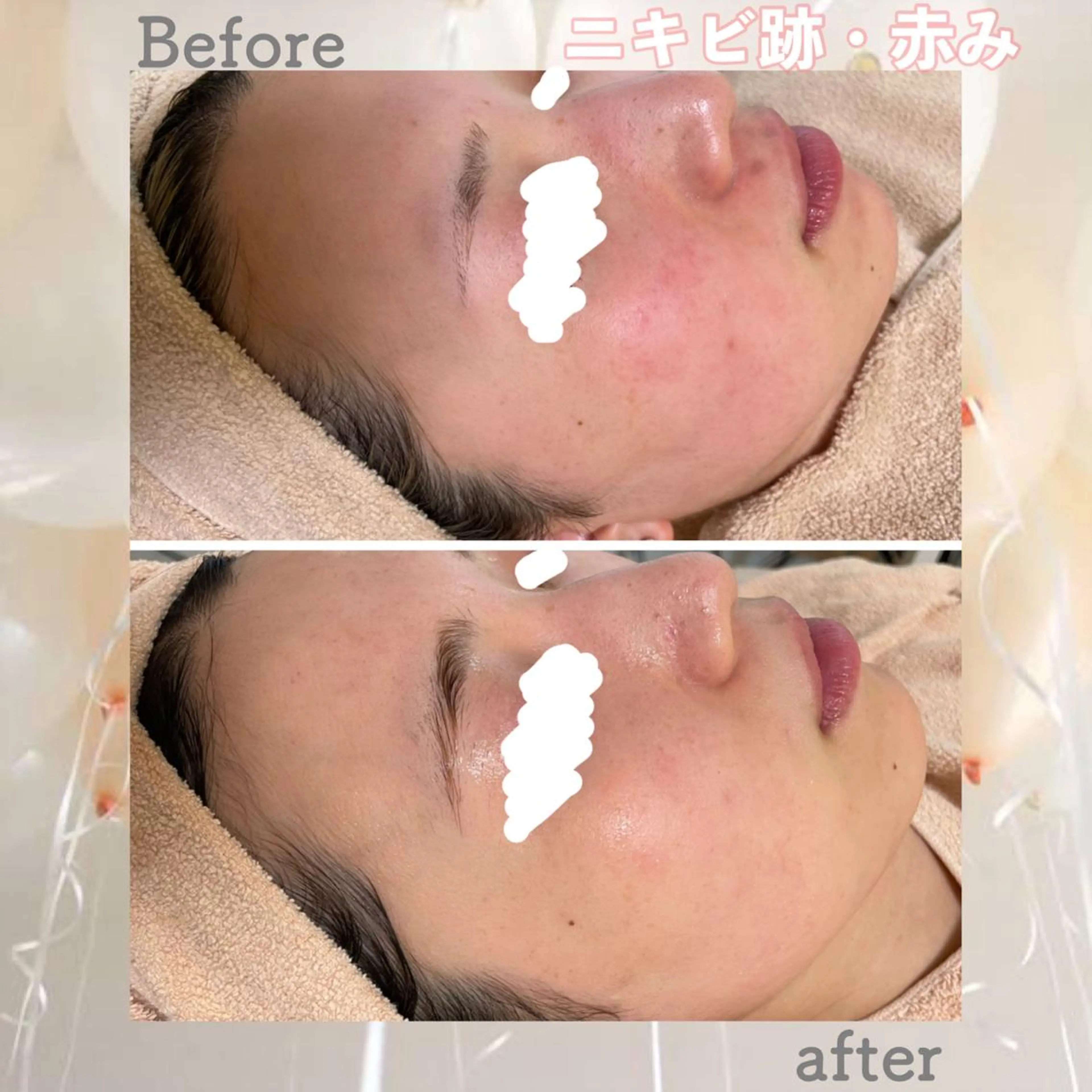 セミロング カラー パーマ ヘアアレンジ メンズ キッズ ネイル マツエク・マツパ アイブロウ 赤色 エステ ニキビ&跡改善サロン オーナー光木のエステ・リラクイメージ