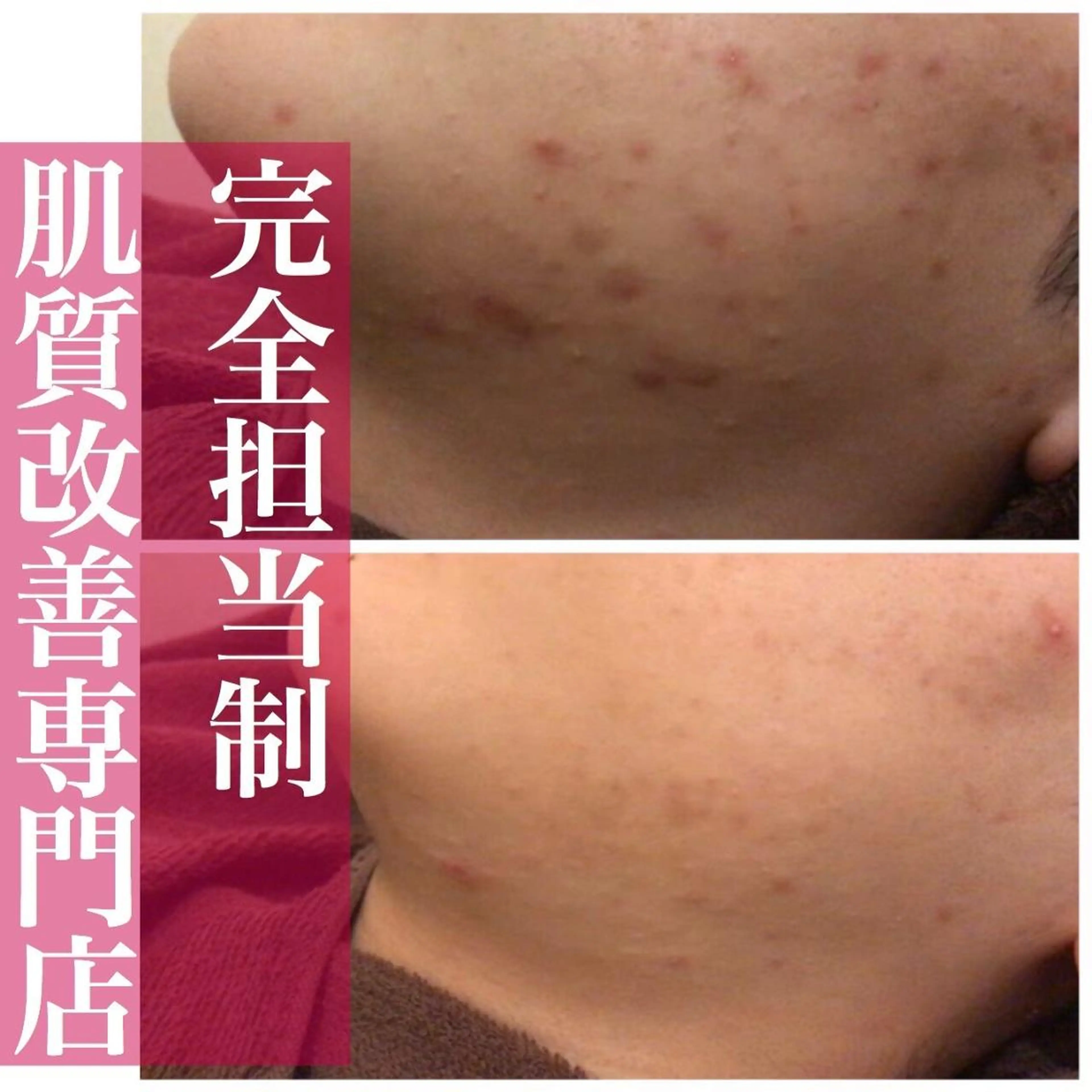 🔥3か月で肌革命 🔥ニキビ専門店のエステ・リラクイメージ