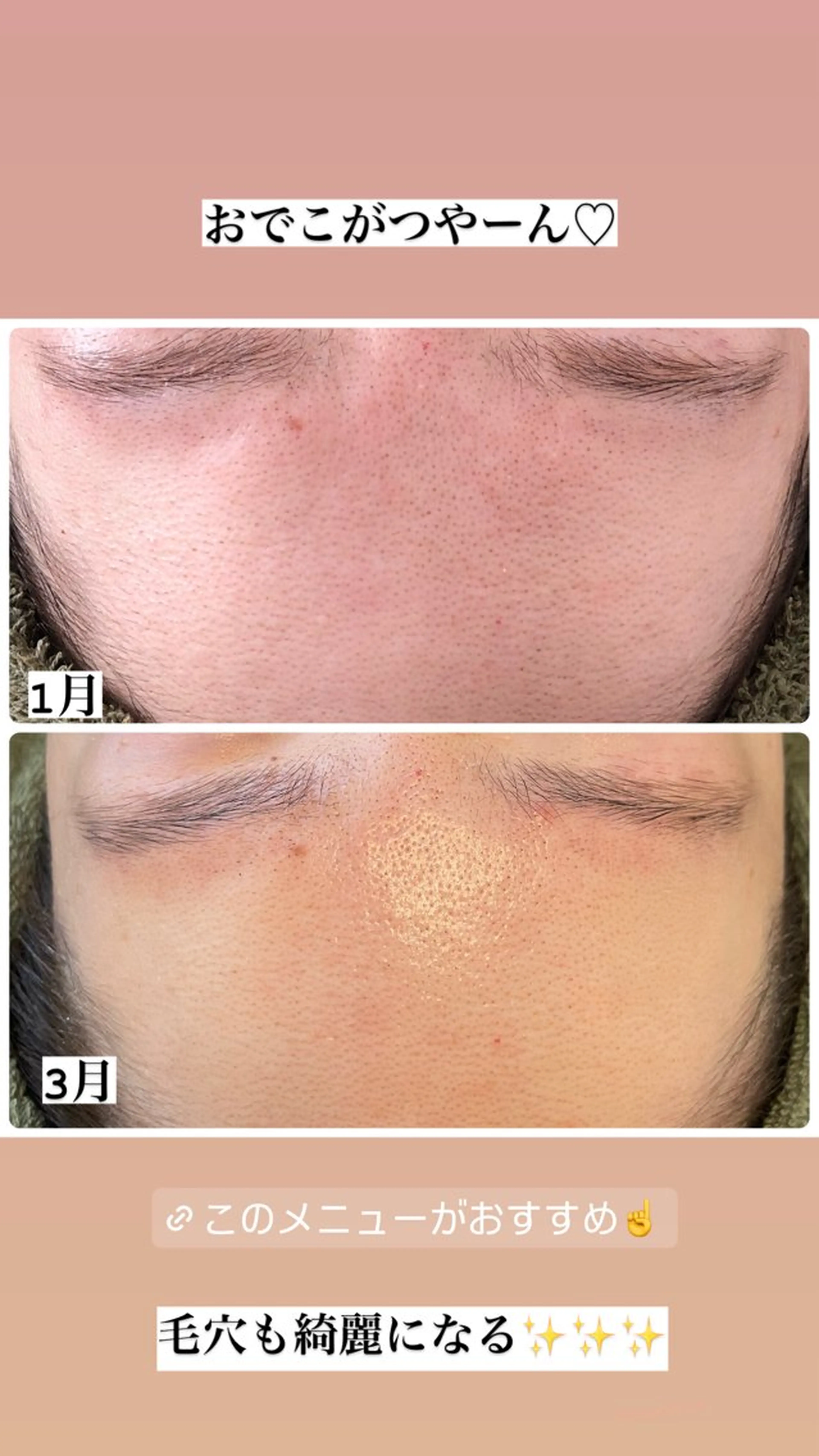 エステ ニキビ・毛穴改善 🌿ハーブピーリングのエステ・リラクイメージ