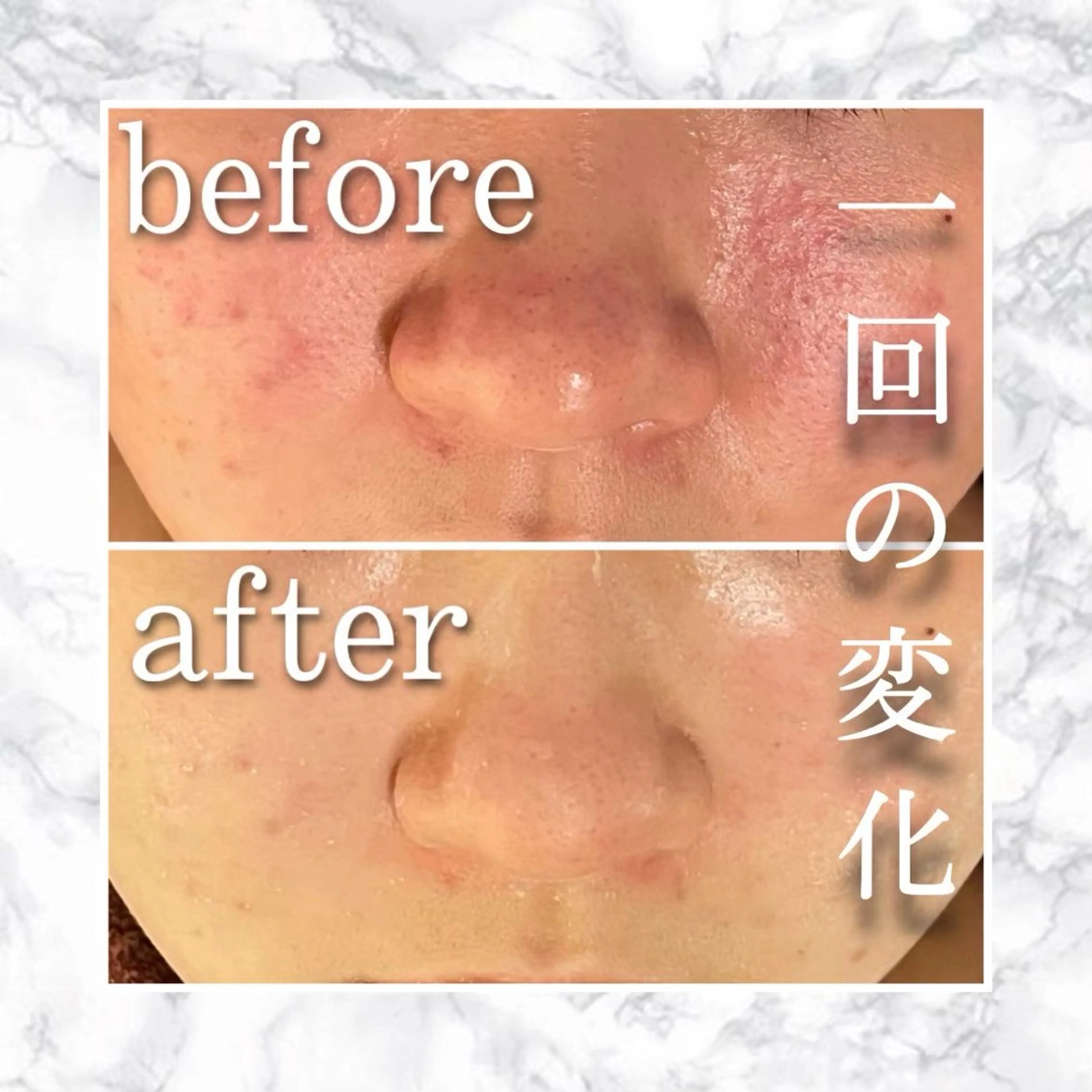 エステ リラク ニキビ跡改善専門🔥 医療にはできない改善のエステ・リラクイメージ