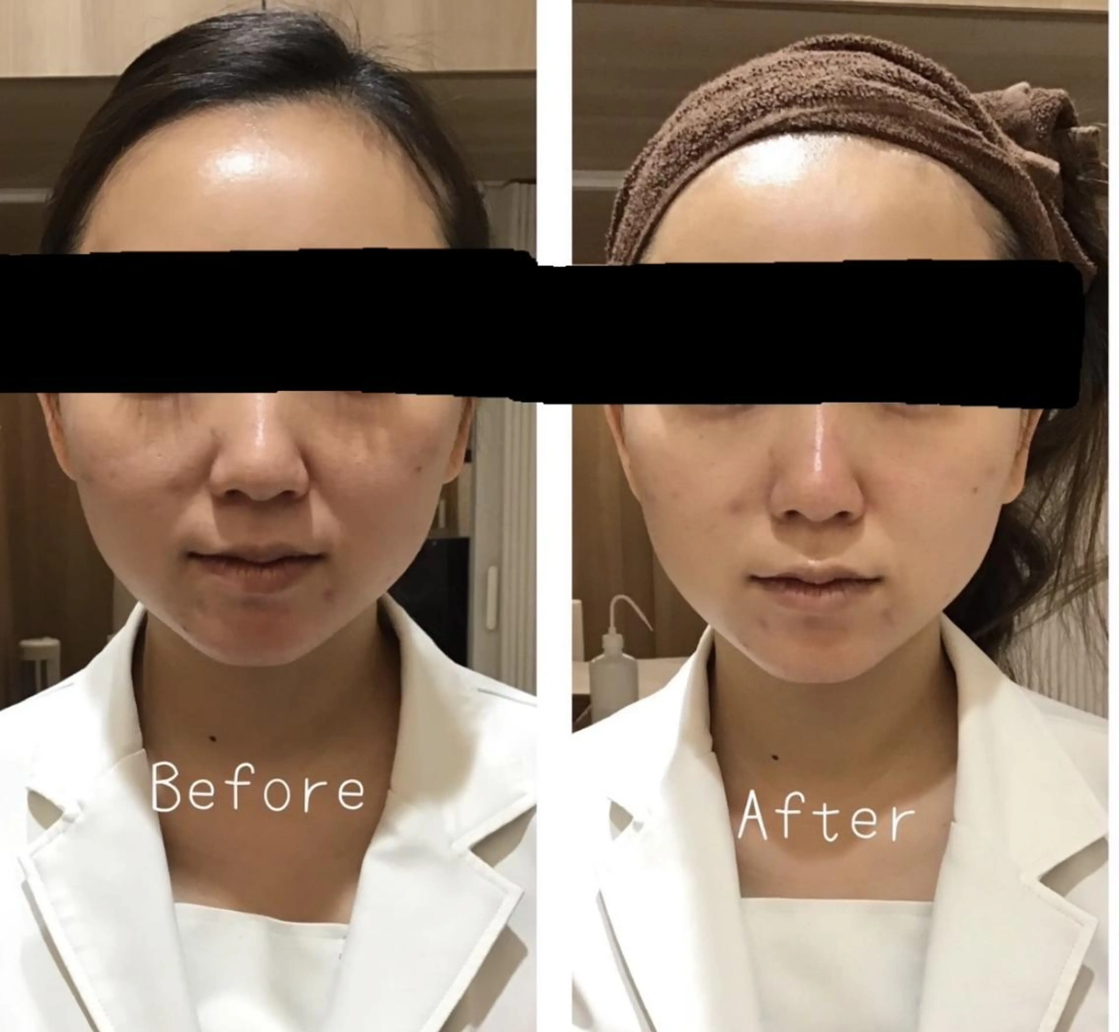 ダブル幹細胞×サーマルフラクショナル🧸🎈30分打ち放題🧸🎈毛穴引き締め/リフトアップ/小顔/ハリ/くすみ🧸🎈の写真