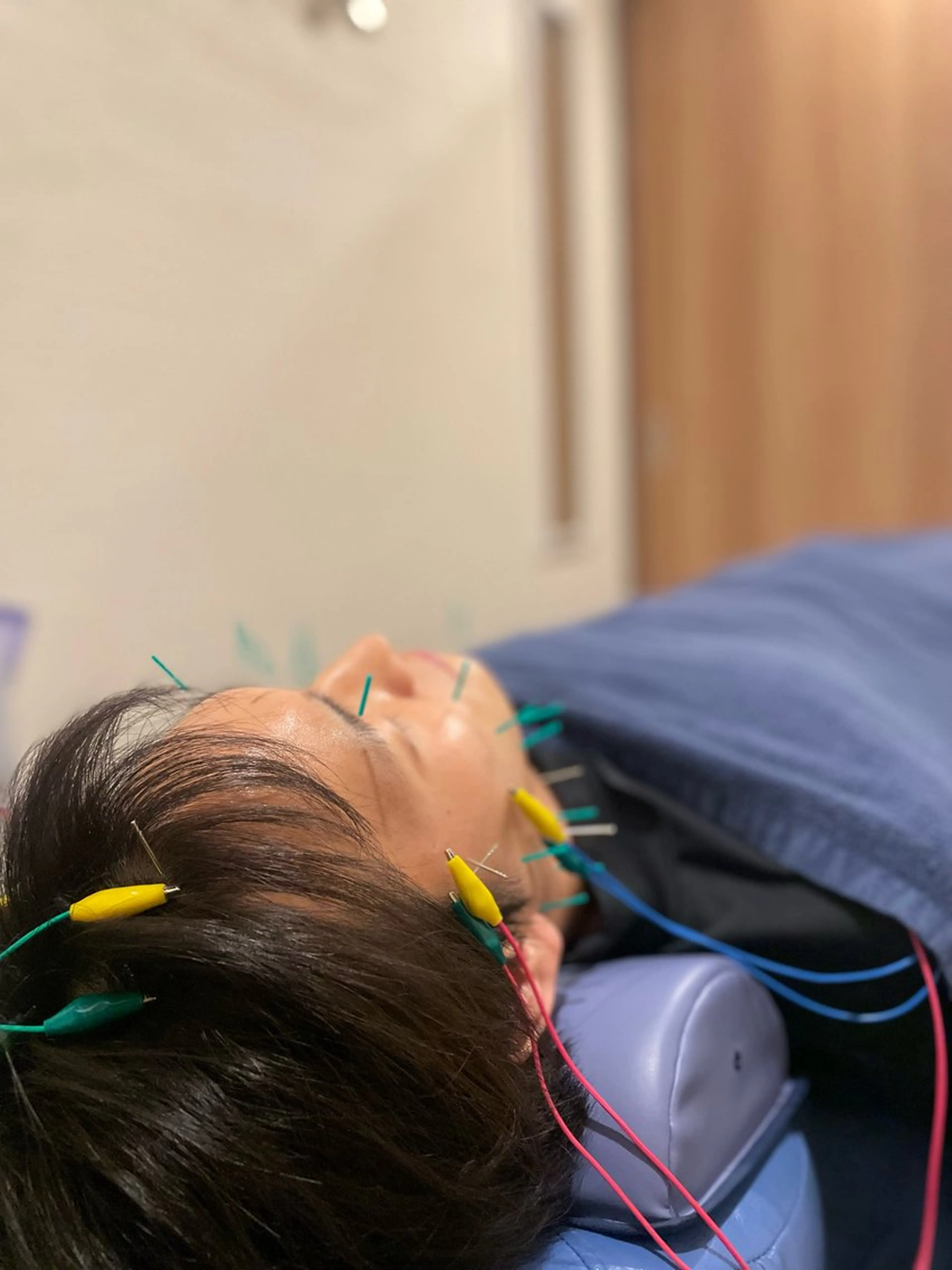 【浮腫みフェイス撃退🔥】夏に向けて向けてお顔スッキリ❗️美容鍼+微弱電流＋全身整体コース❗️日常のお悩みにも対応！の写真