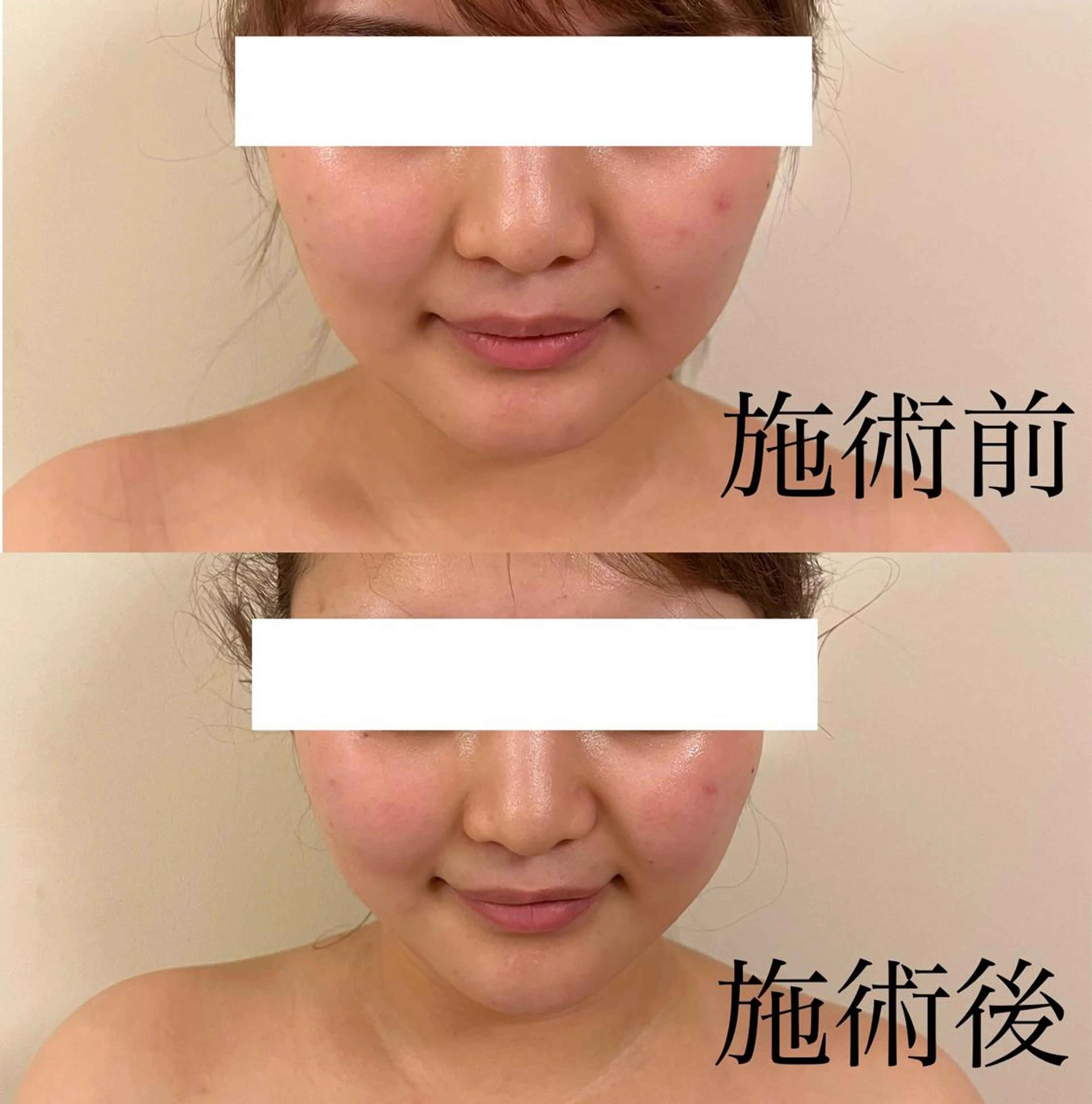 WOM SALON所属・MIKU【美容整形ダ ウンタイムケア銀座】のエステ・リラクイメージ