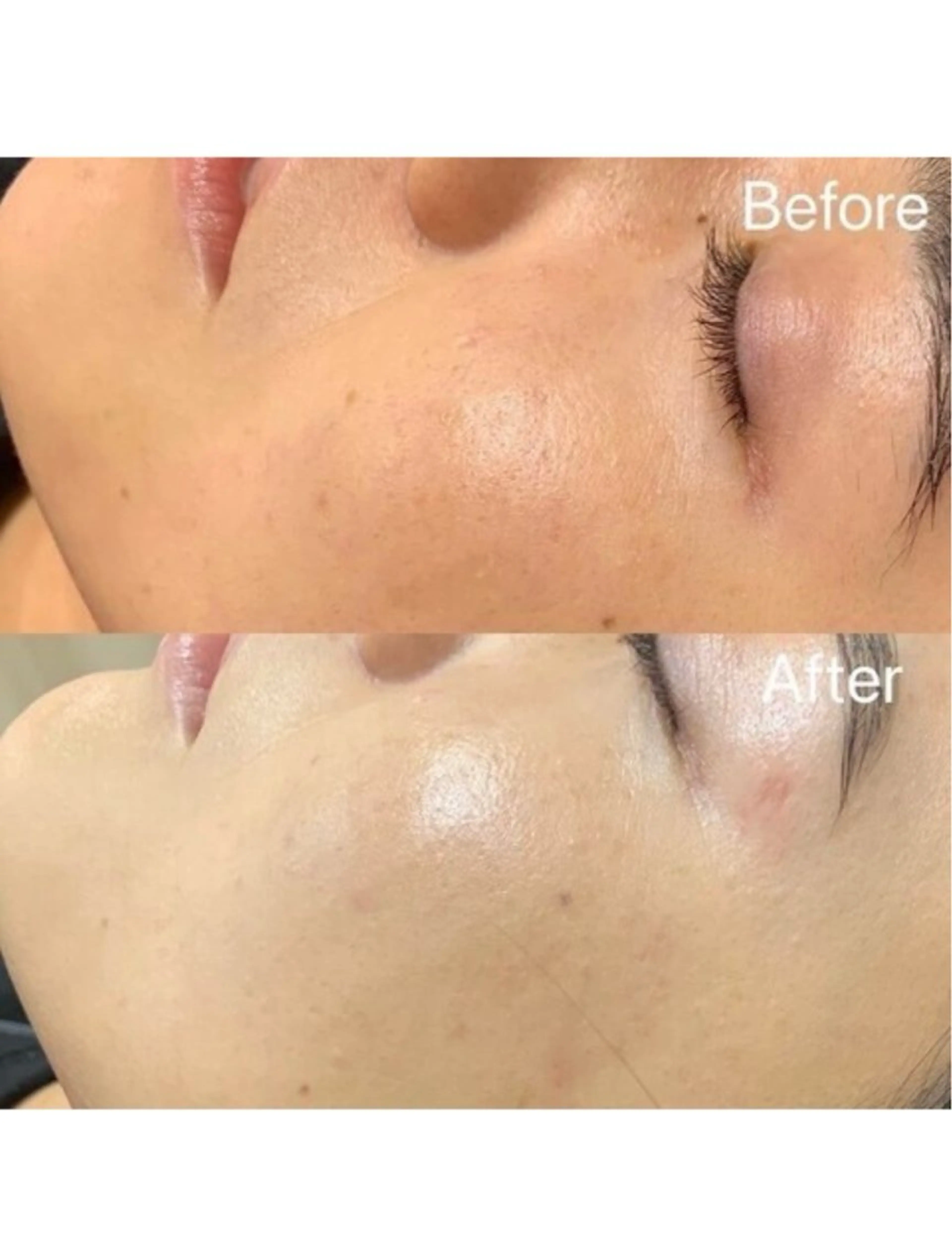 【肌本来の艶・透明感肌に】フェイシャルワックス脱毛 初回お試しの写真