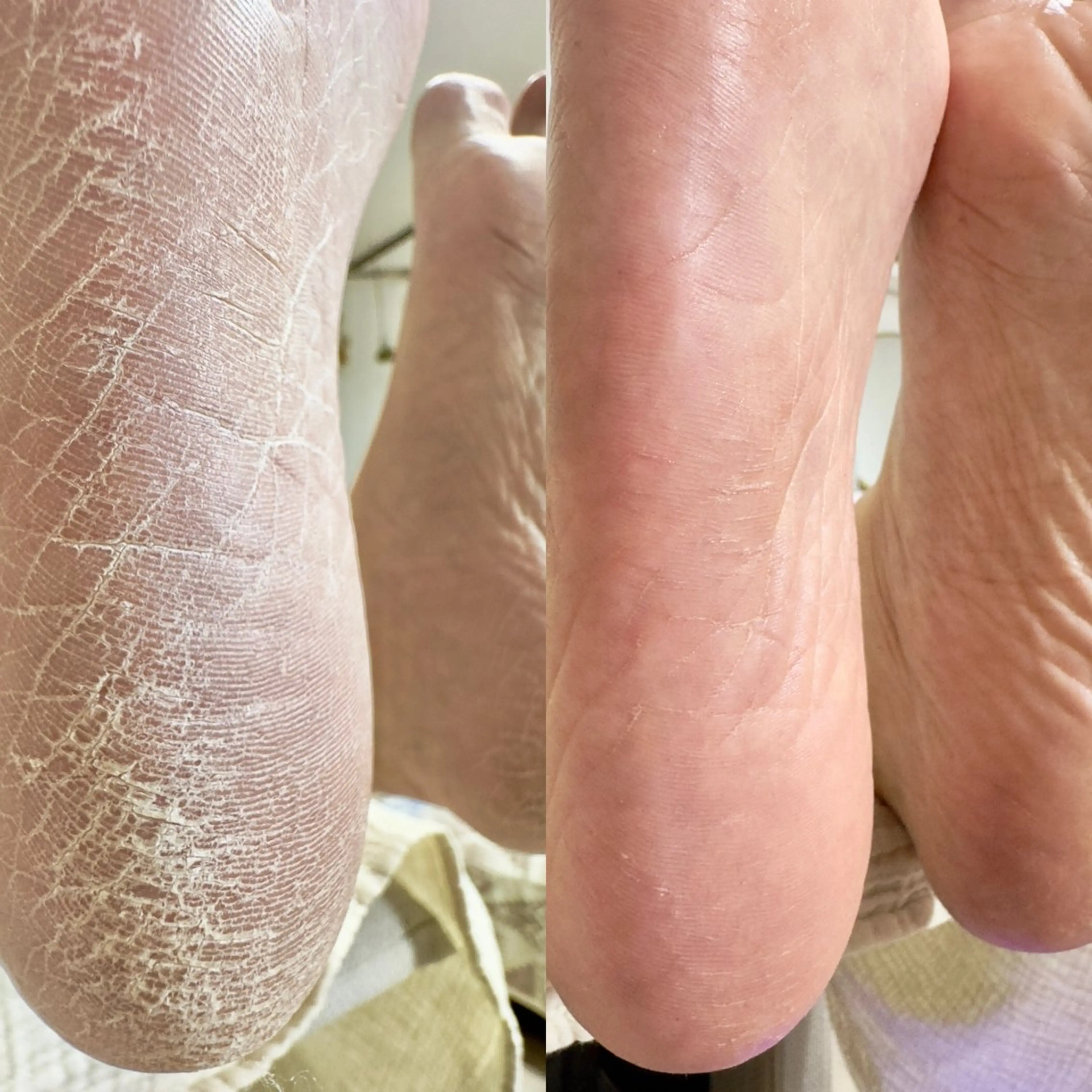 足裏角質ケアの写真