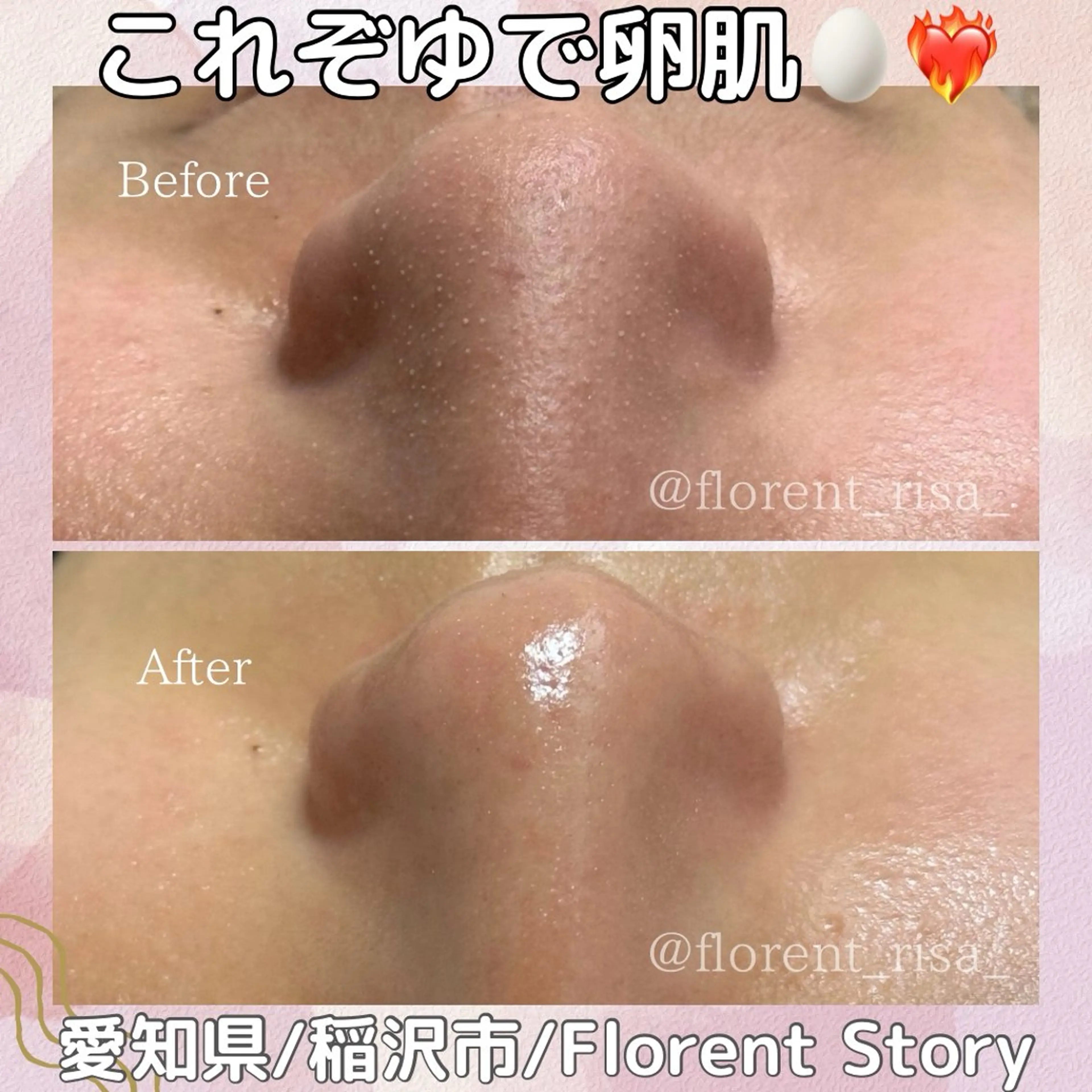 【ミニモ限定】お肌の基盤から整える毛穴洗浄☆ツヤもち肌への写真