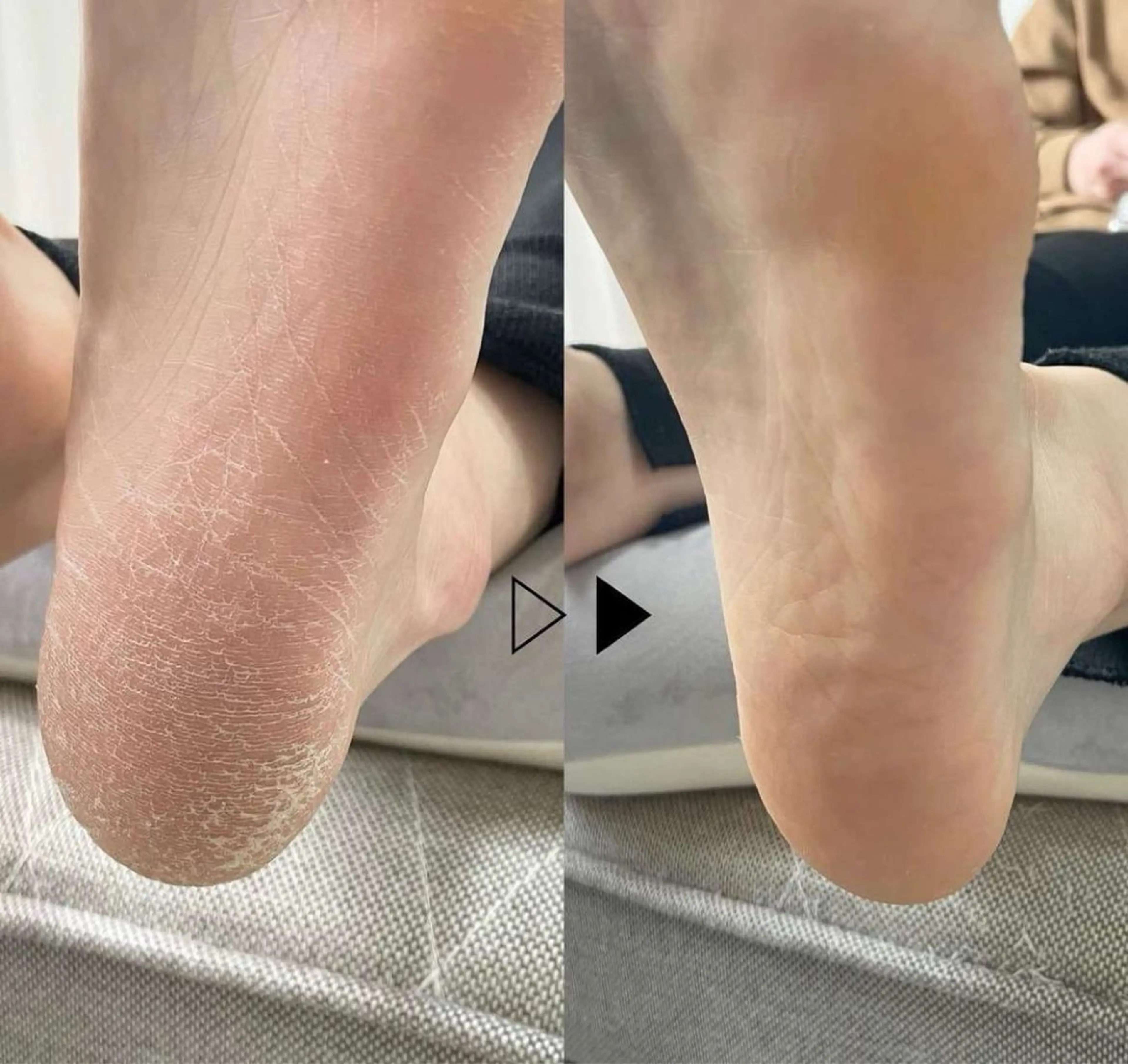 foot角質除去 無料モデル限定２名募集 10:00-11:00-の写真