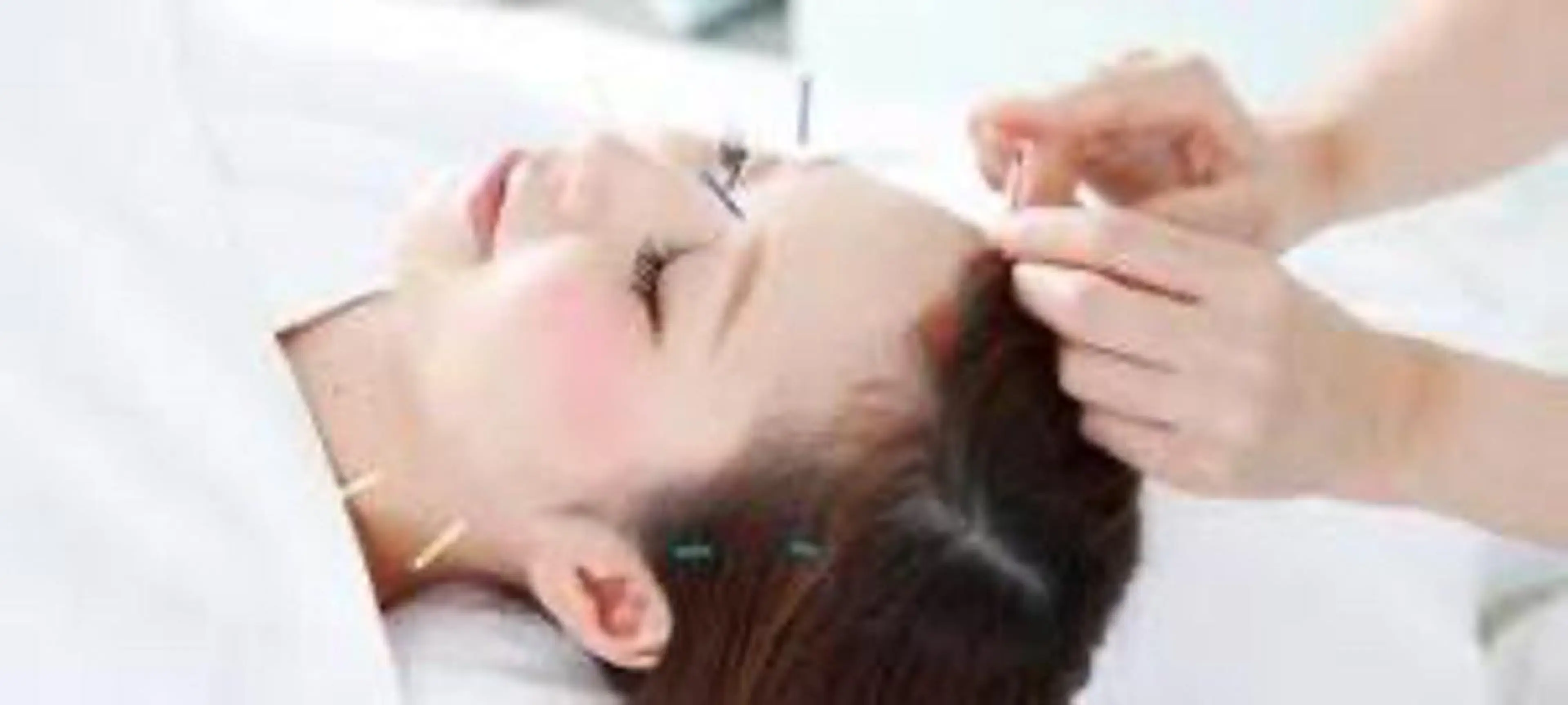 【25歳以下限定】美容鍼灸8900→2500の写真