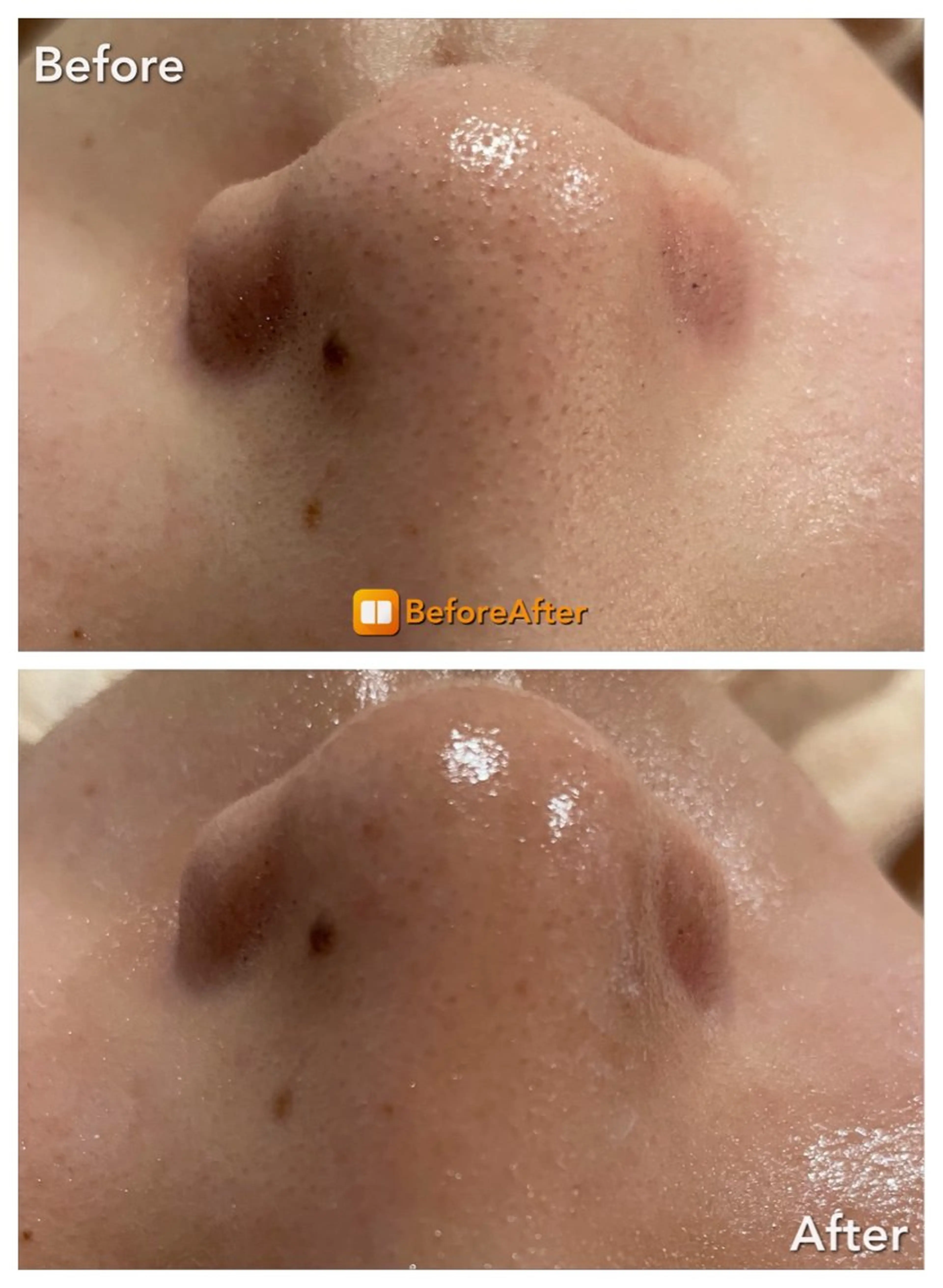 エステ Meupニキビ専門店 背中/ハーブ/肌管理のその他イメージ