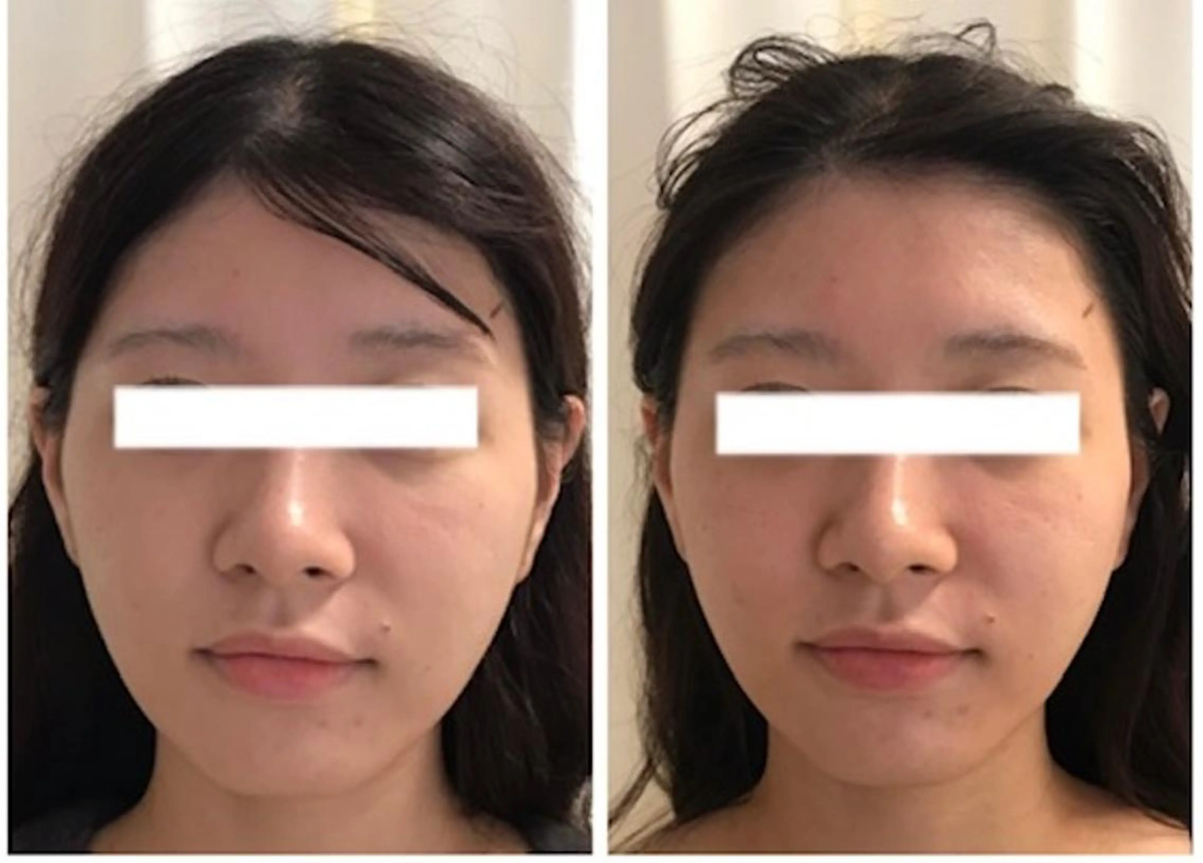 エステ 顔脱毛＆毛穴＆ニキビ 優良№1♪ヒロコ♪のエステ・リラクイメージ