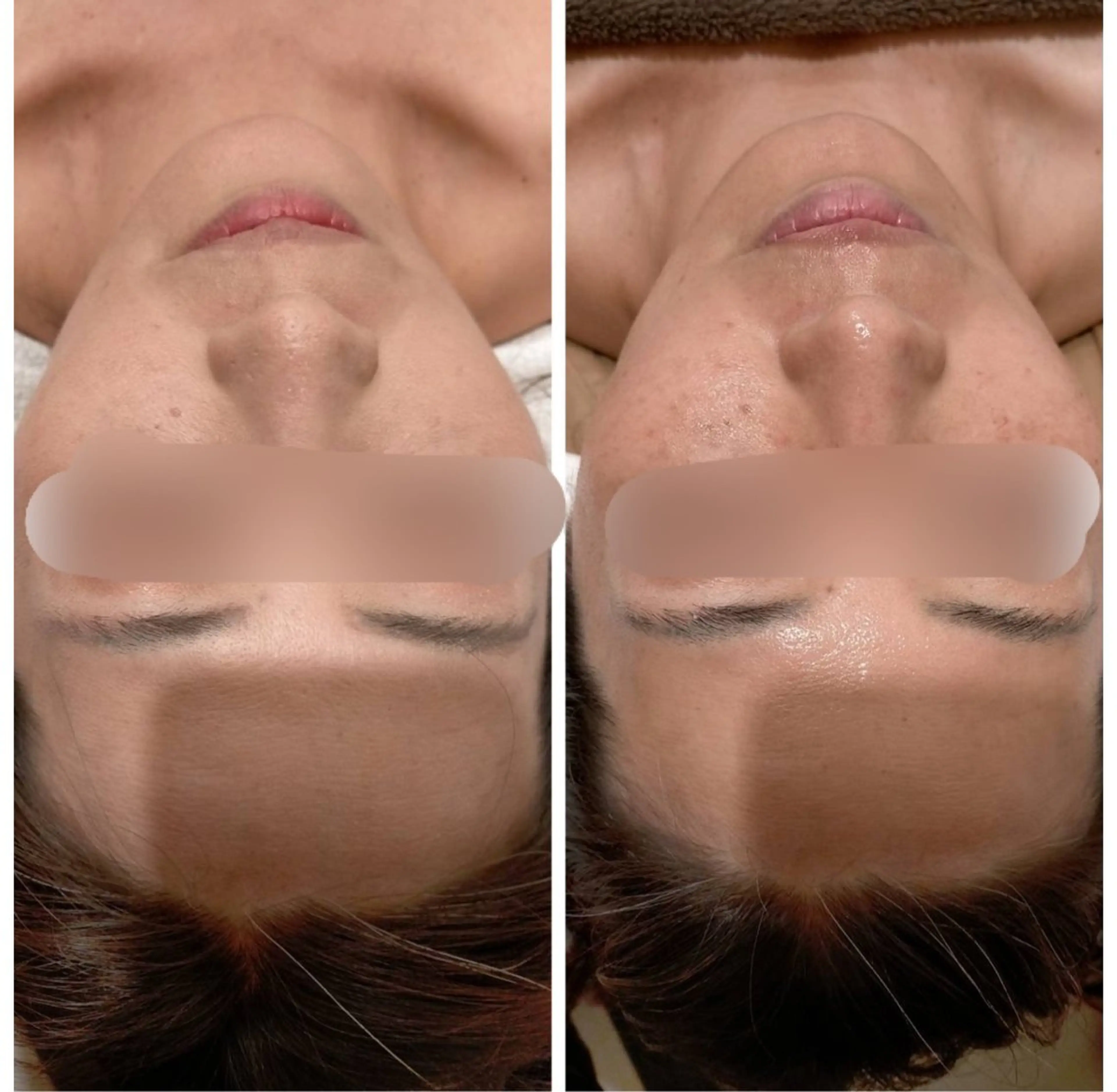 頭蓋骨小顔矯正 ハーブピーリングのエステ・リラクイメージ