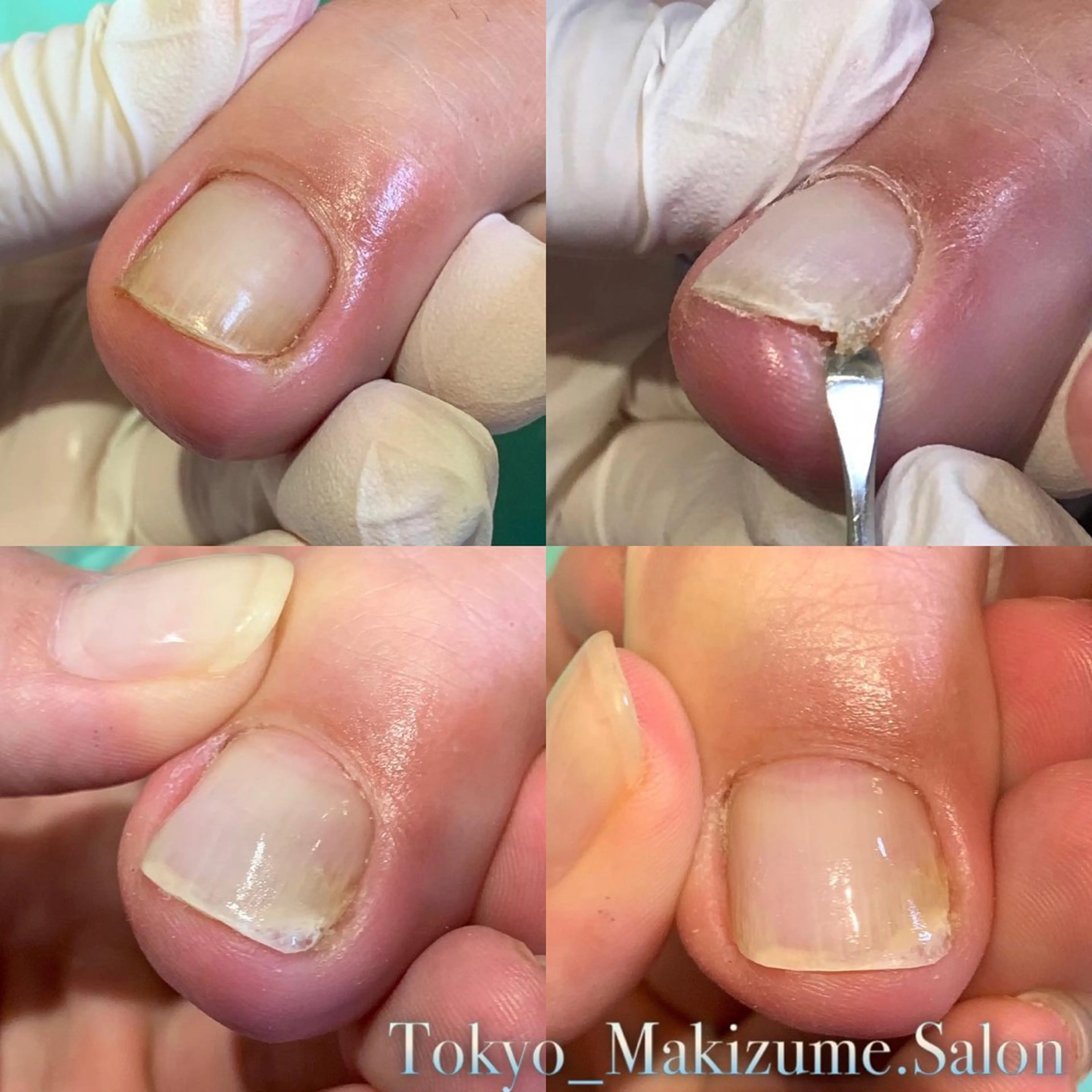 巻き爪補正店　柏店所属・巻き爪補正店 柏店のその他イメージ