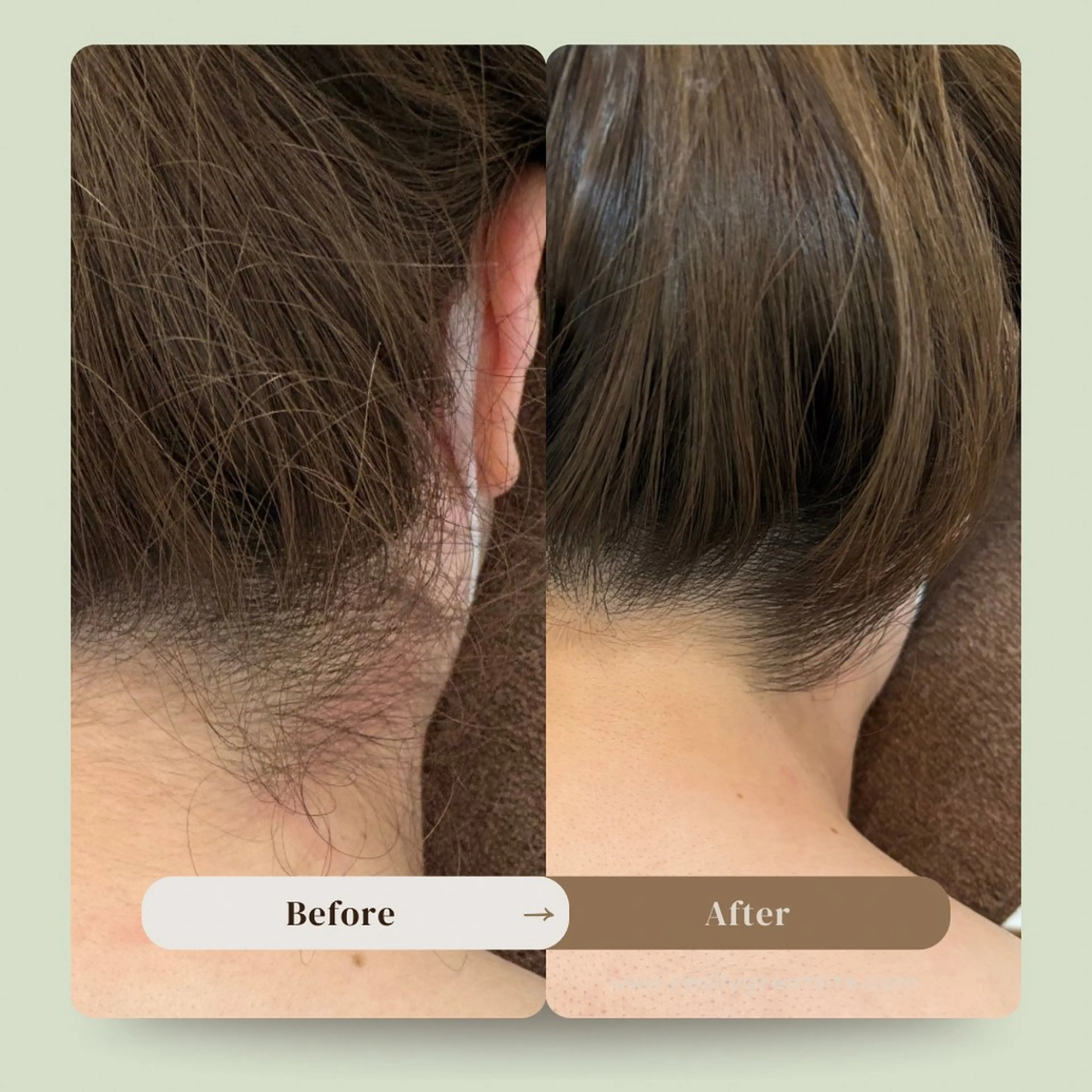 ✨うなじ脱毛✨の写真