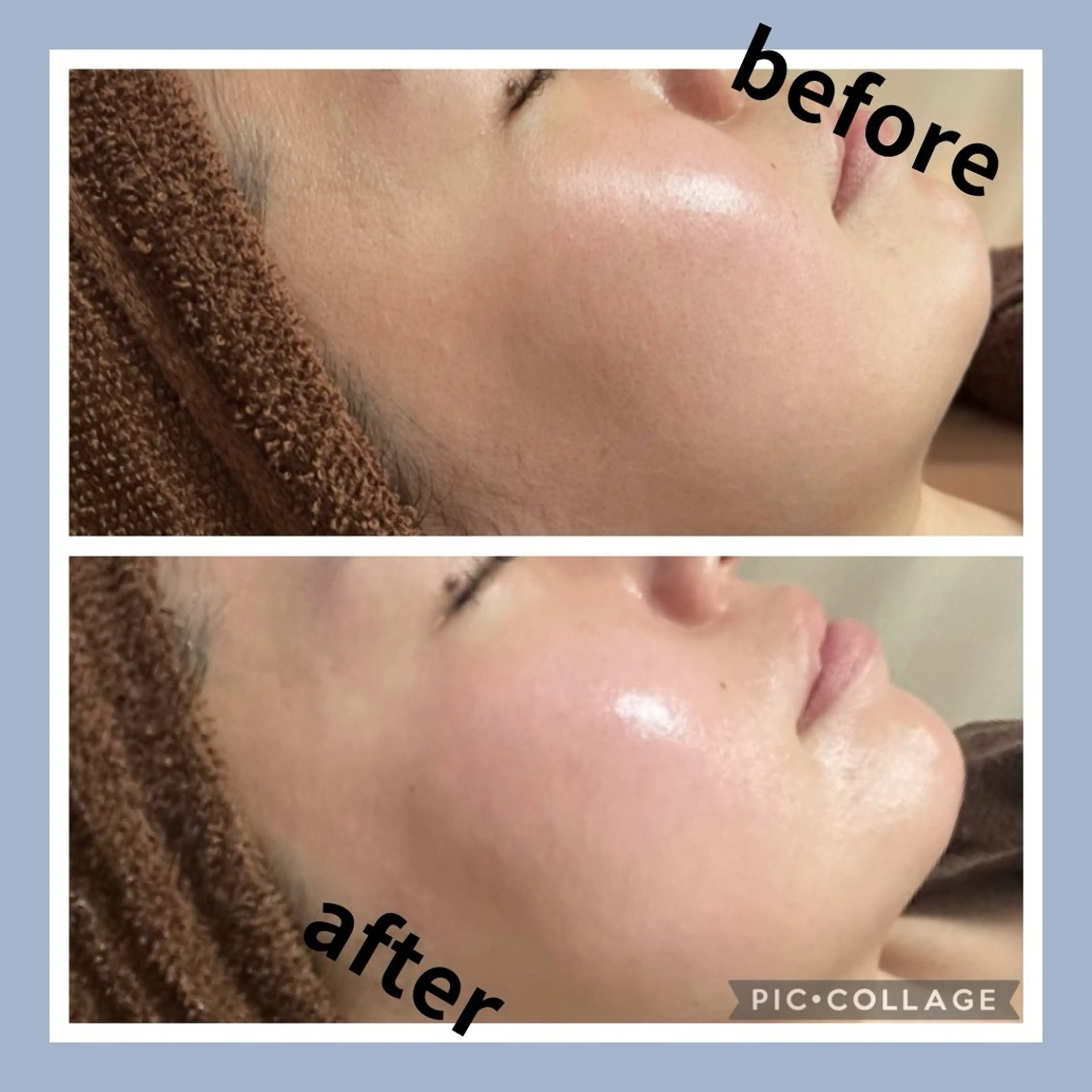 【目指せ水光肌！】ハーブピーリングの写真