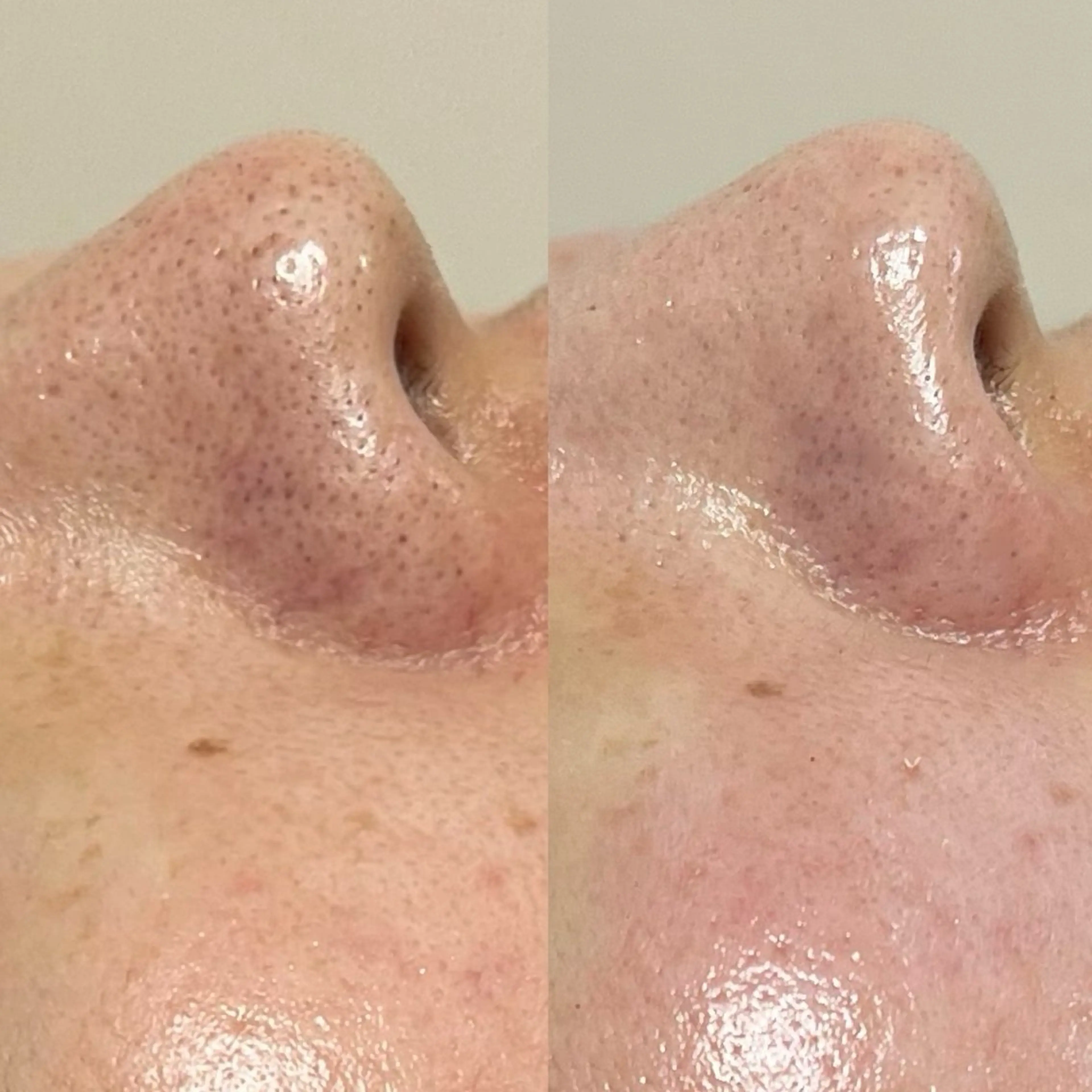 🪨【黒ずみ毛穴つるん！ふわふわ毛穴へ】REVIハーブピーリング《陶肌トリートメント》 ➕ エンザイム1gの写真