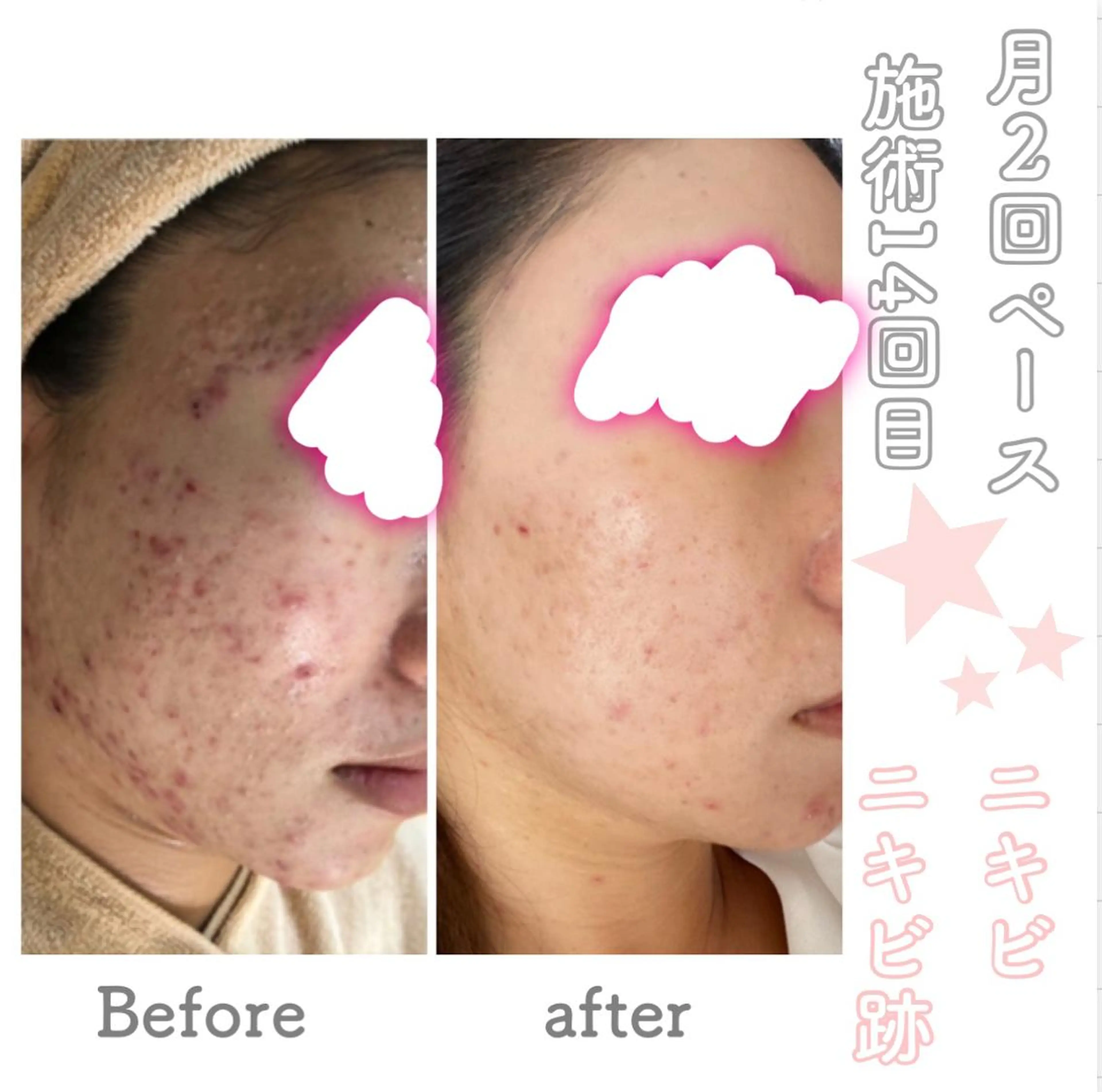 ショート カラー パーマ ヘアアレンジ メンズ キッズ ネイル マツエク・マツパ エステ ニキビ&跡改善サロン オーナー光木のエステ・リラクイメージ