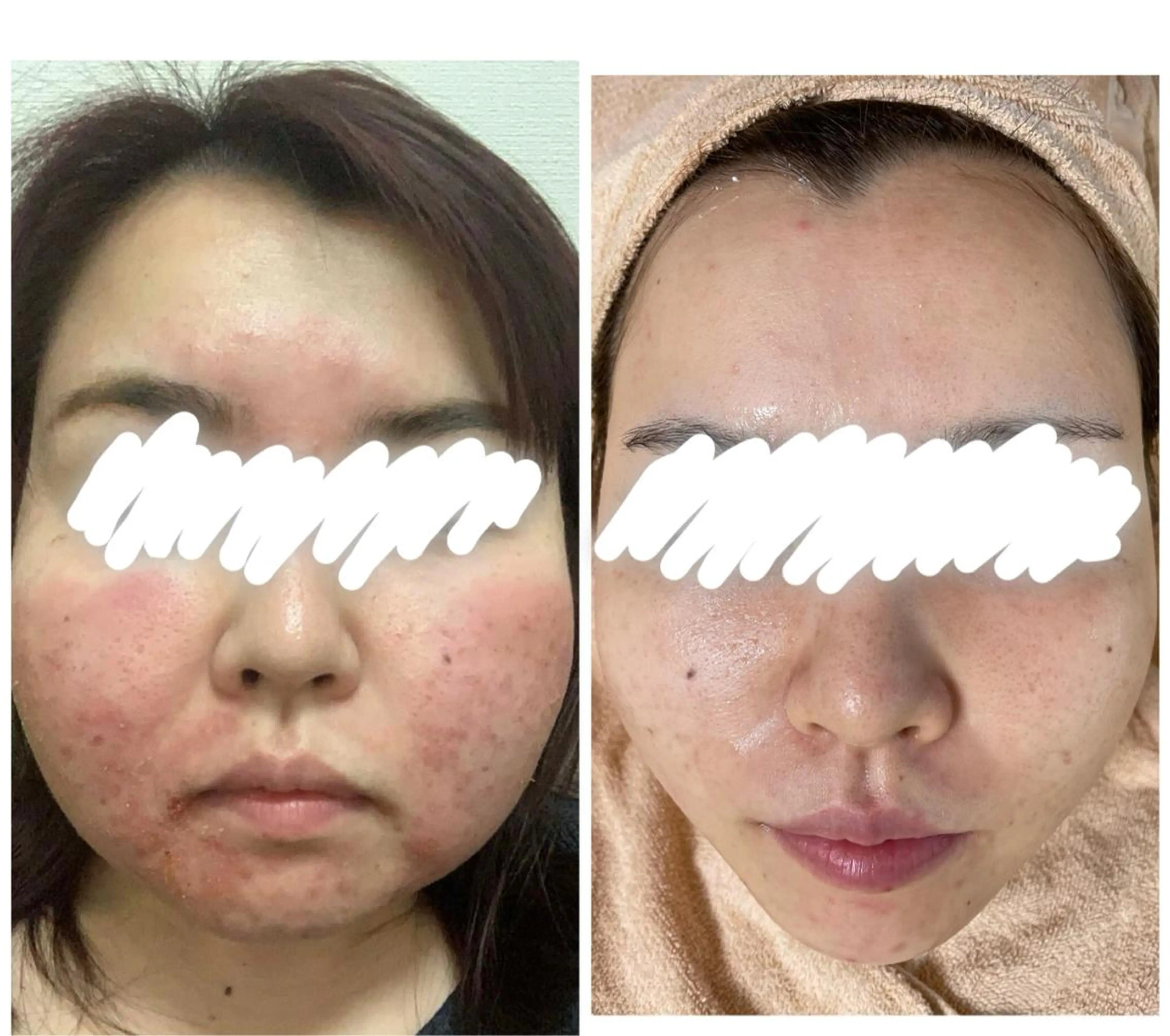 ミディアム カラー パーマ ヘアアレンジ メンズ キッズ ネイル マツエク・マツパ エステ ニキビ&跡改善サロン オーナー光木のエステ・リラクイメージ