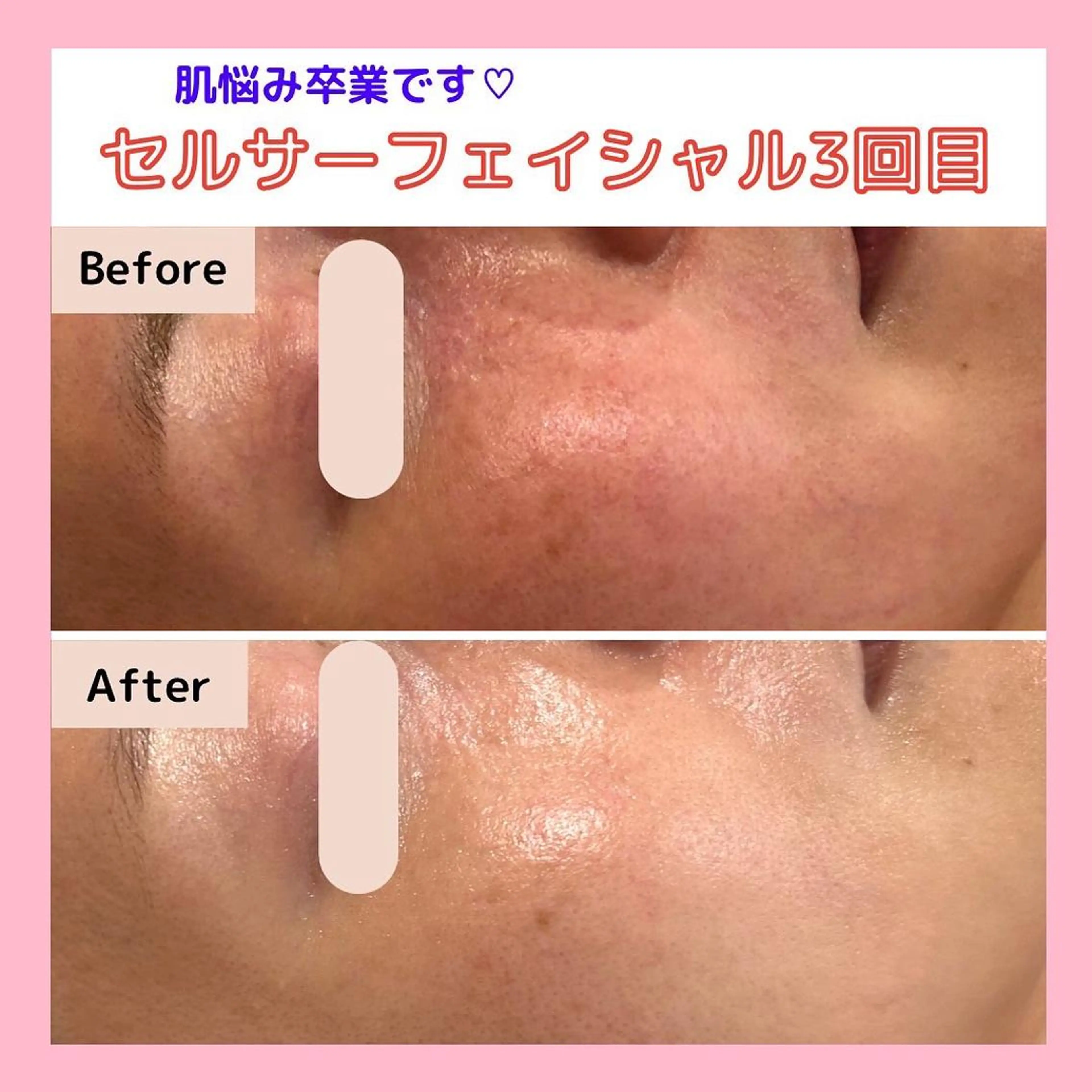 【マスク老化・敏感・乾燥肌徹底改善！】肌内側から透明感溢れる潤い肌に☆ﾏｽｸで隠す肌から見せる肌への写真