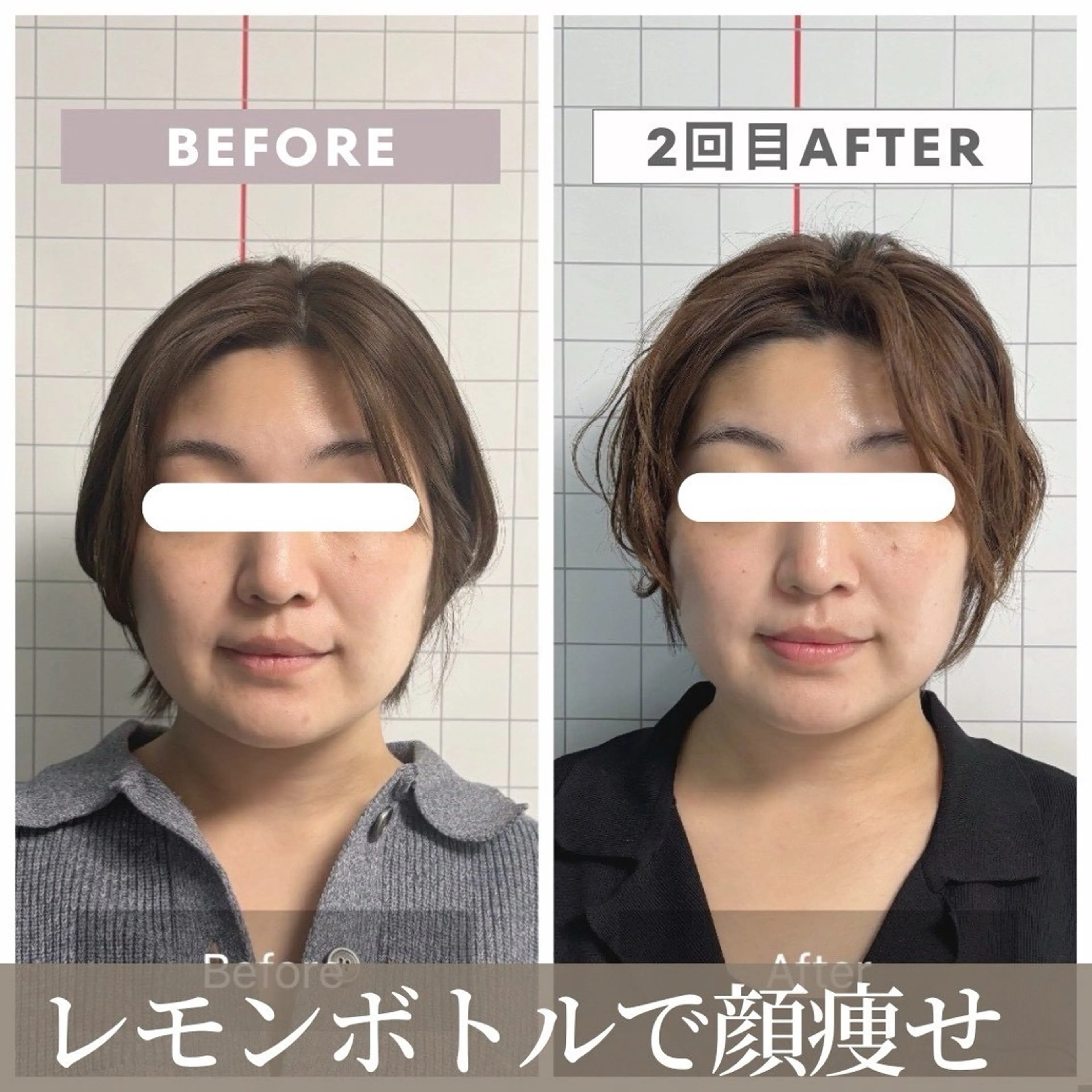 【二重アゴ・頬肉・小顔】RFリフトx小顔矯正×脂肪擊退REDSHOTの写真