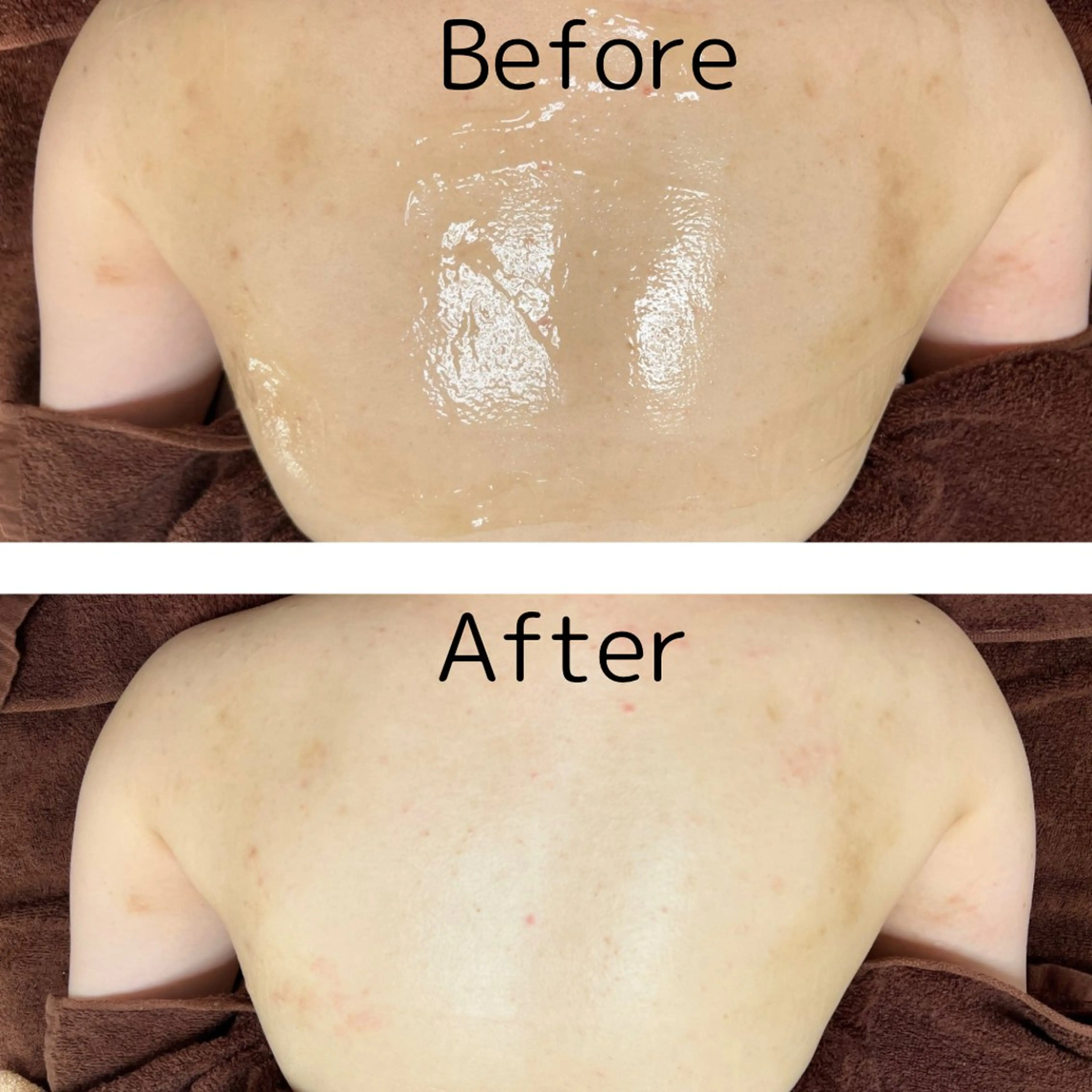 【自信の持てる美背中トリートメント】黒ずみ＆ブツブツ、ニキビ跡集中トリートメント✨の写真