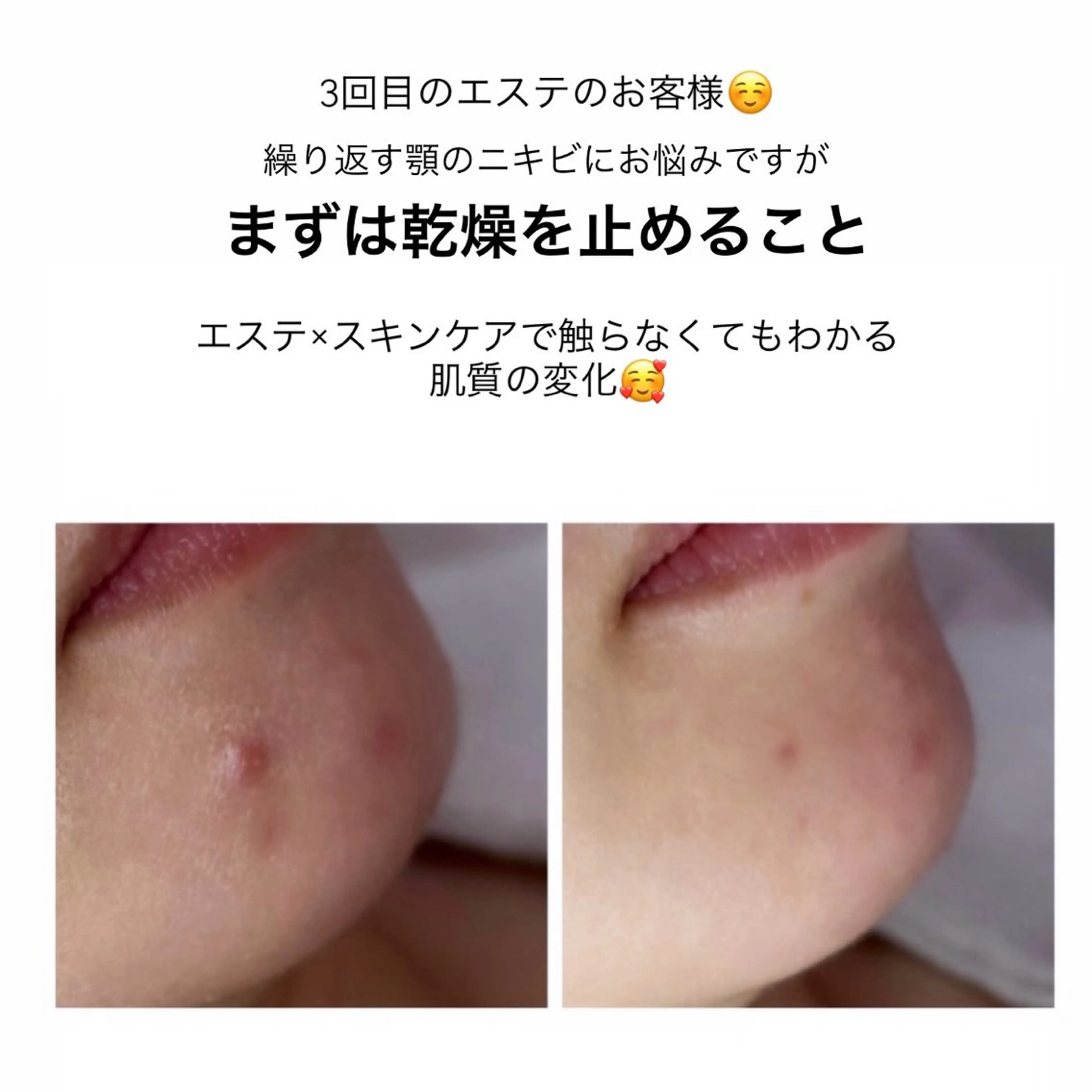 エステ ニキビ/敏感肌/乾燥 Lilyauraのエステ・リラクイメージ