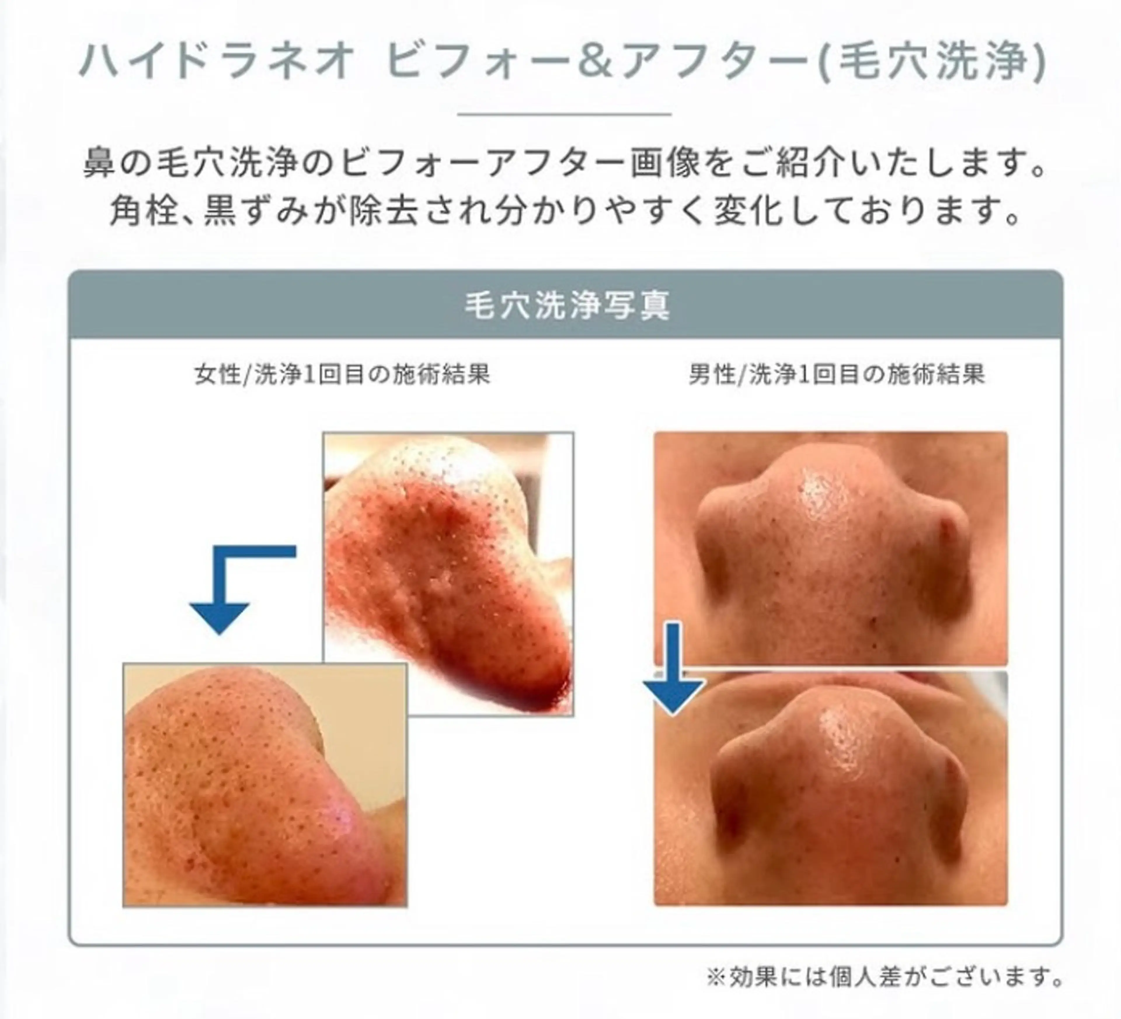 毛穴洗浄機＋美容液導入！！化粧塗り変わります☆男女OK！の写真