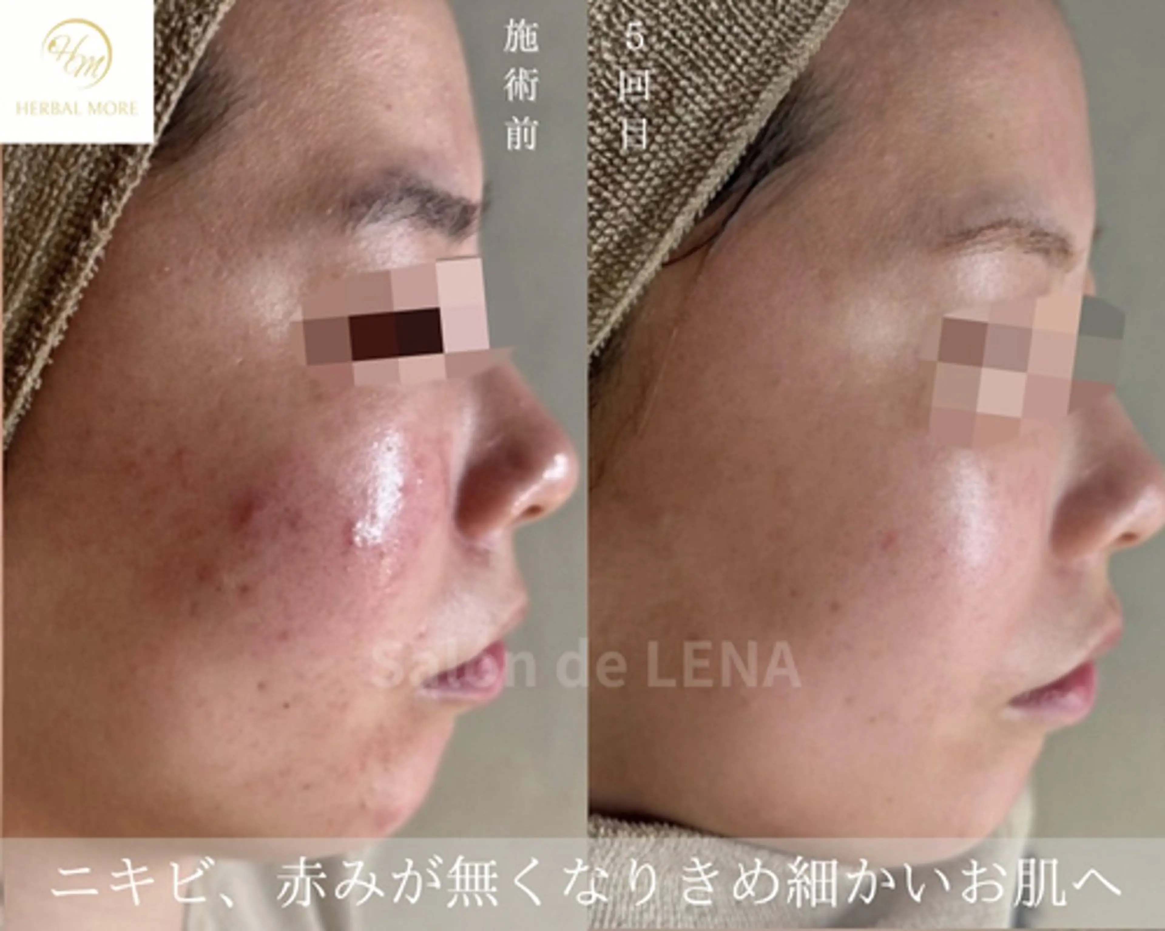 ハーブピーリング・毛穴ケア専門サロンSalon de LENA 栄店所属・ハーブピーリング専門 サロンドレナ　白藤のエステ・リラクイメージ