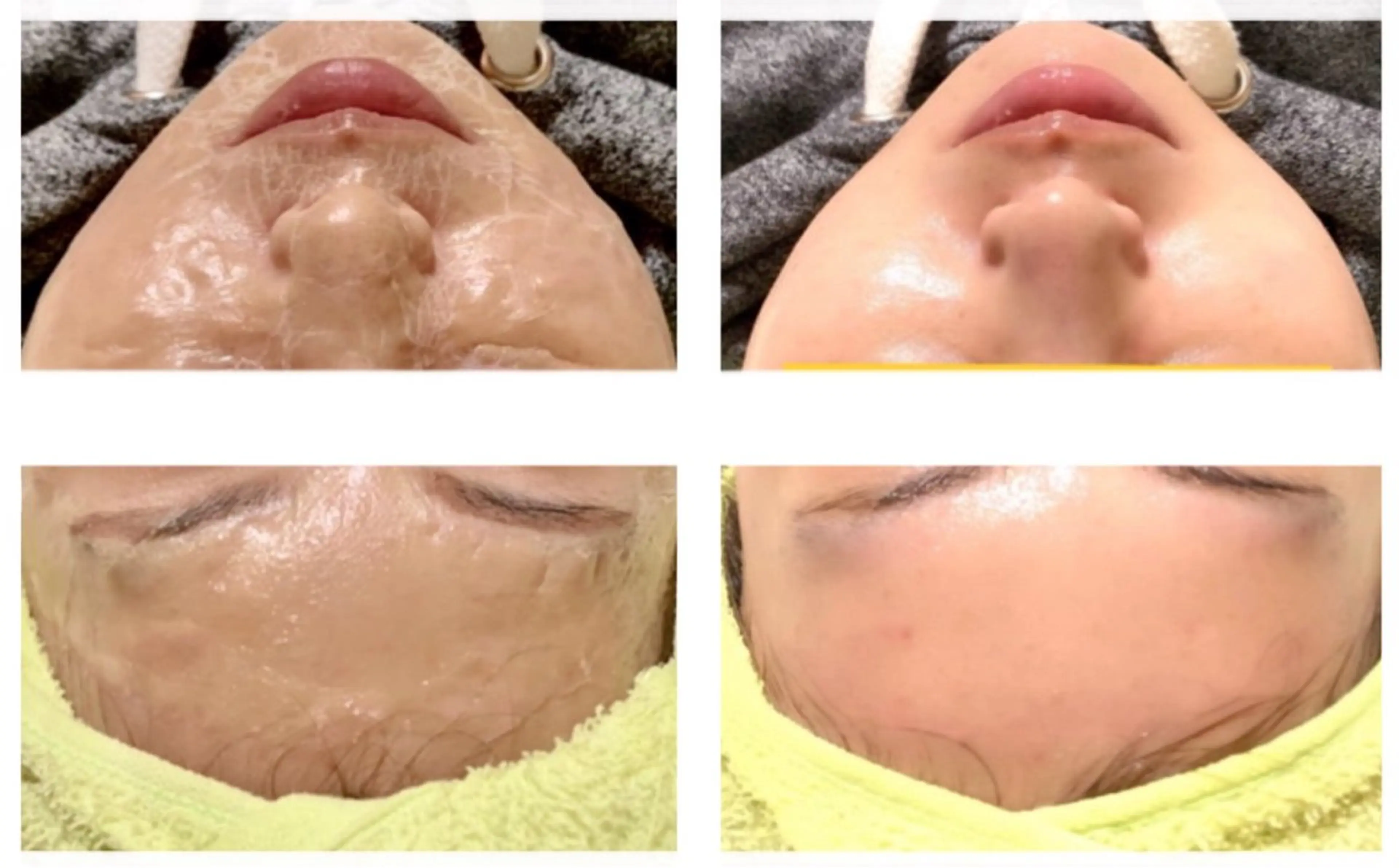 【ハリ・キメ・くすみ・むくみ】 2段階保湿で行うぎゅぎゅーっと固まるアルブミン配合パック✨【フェイシャル】の写真