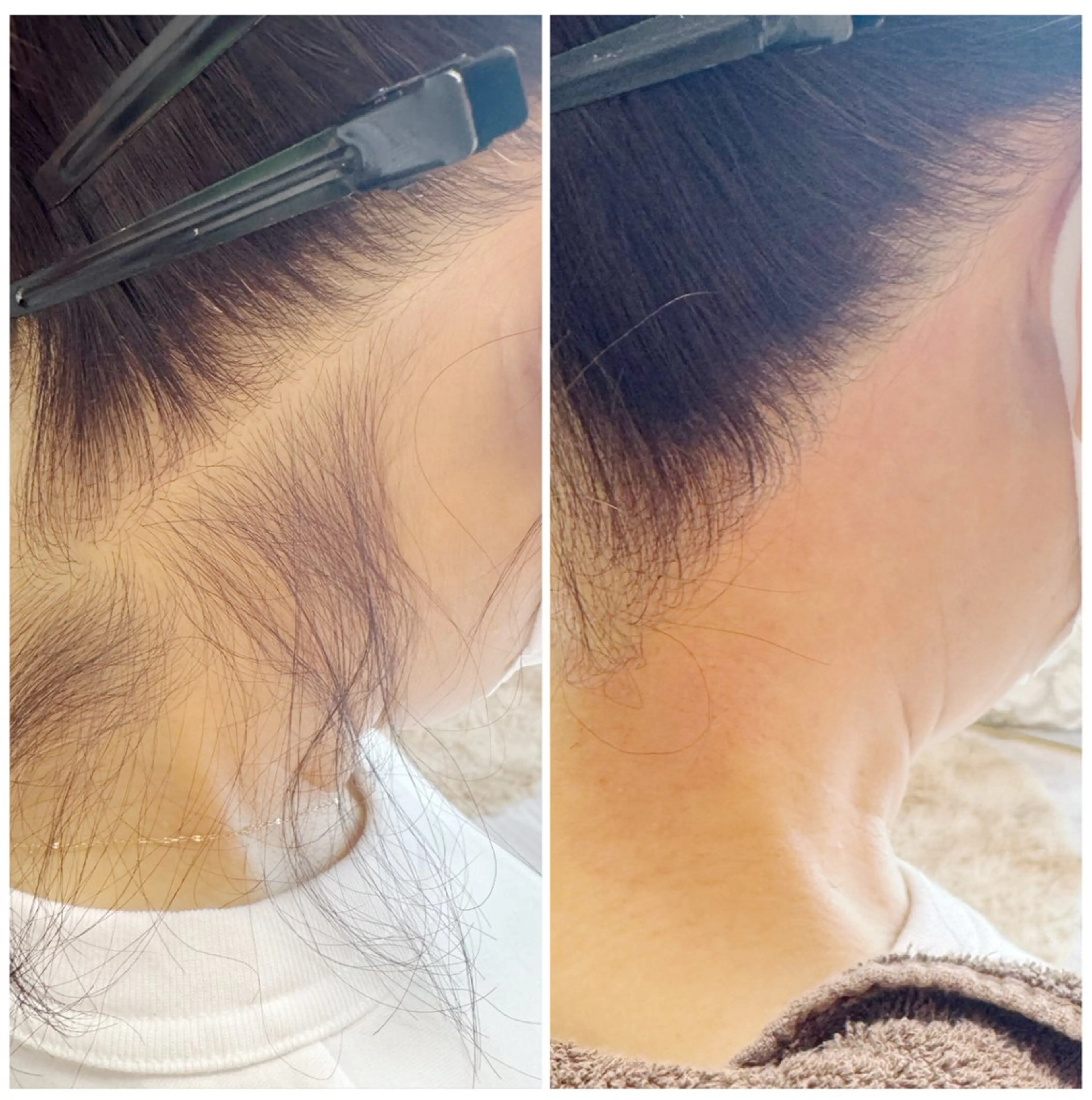 うなじダブル脱毛👱🏻‍♀️ブラジリアンワックス＋最新光脱毛🧡ノーズワックス付き（不要の場合当日お伝えください）の写真