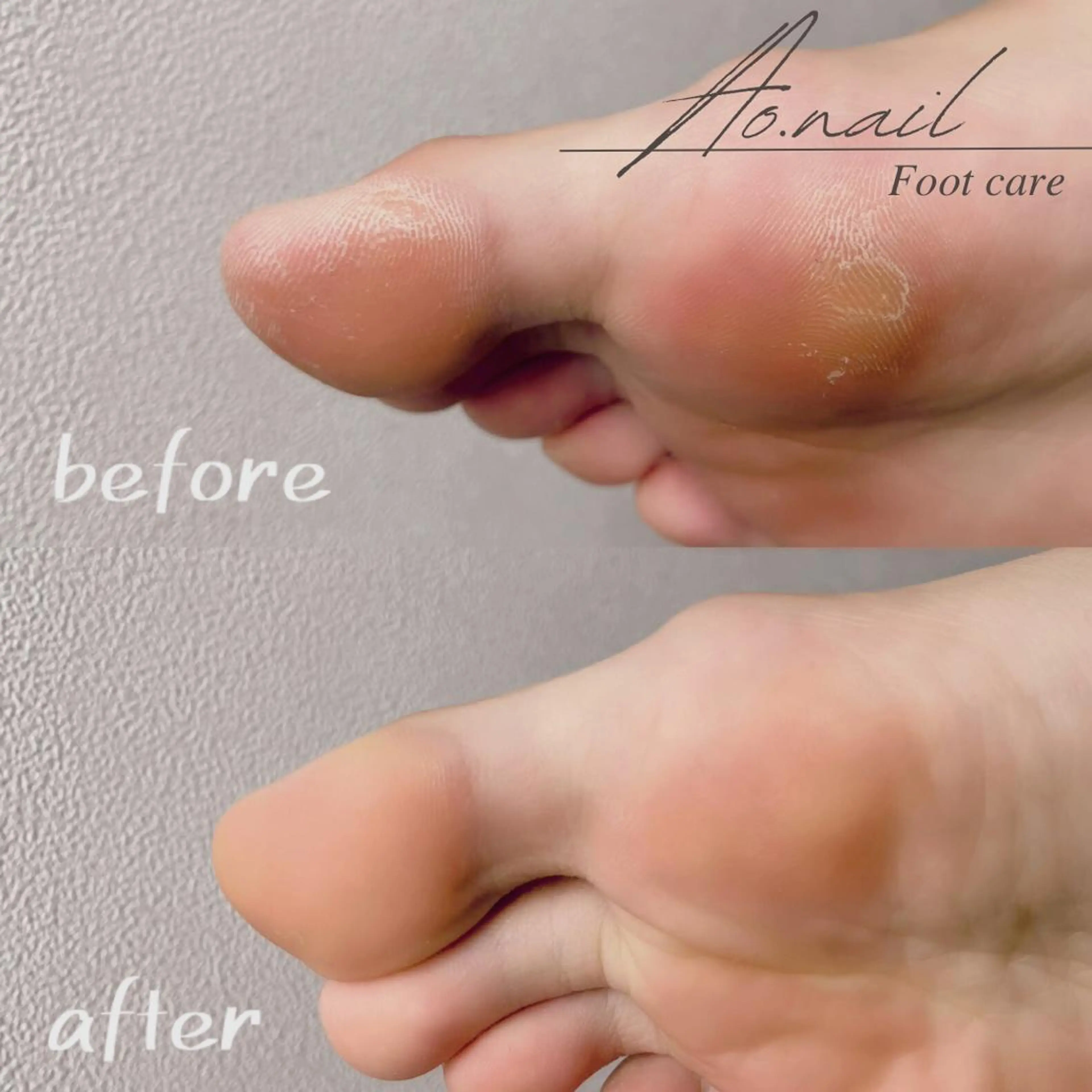 フット角質ケアの写真