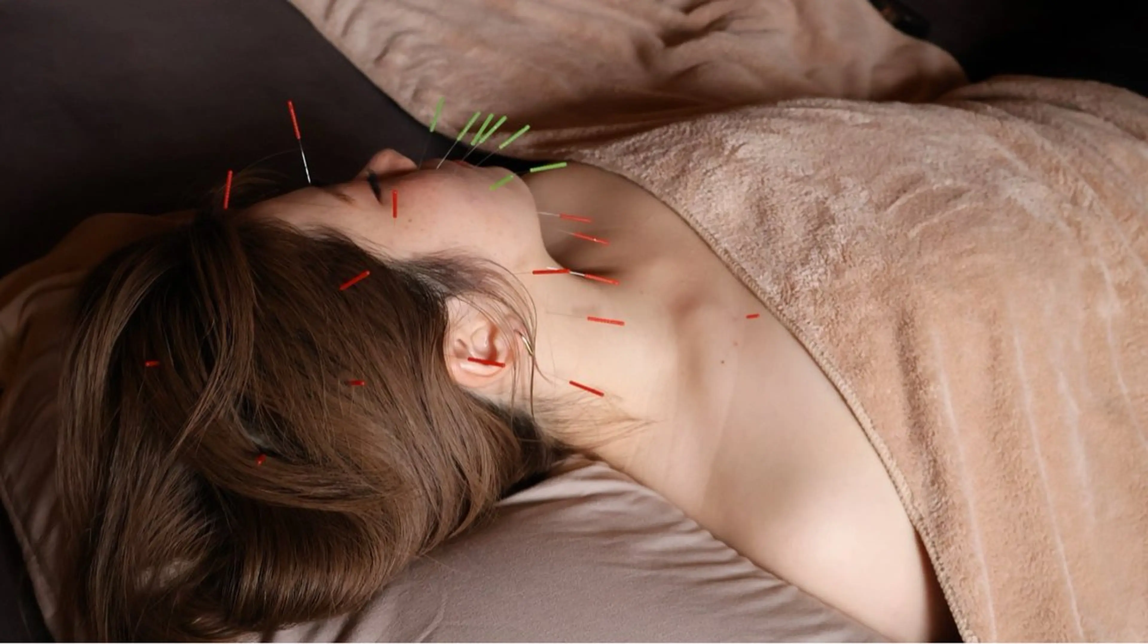 【初回限定】ミニモ限定価格🪡¥6,980小顔美容鍼60分(カウンセリング込み)の写真