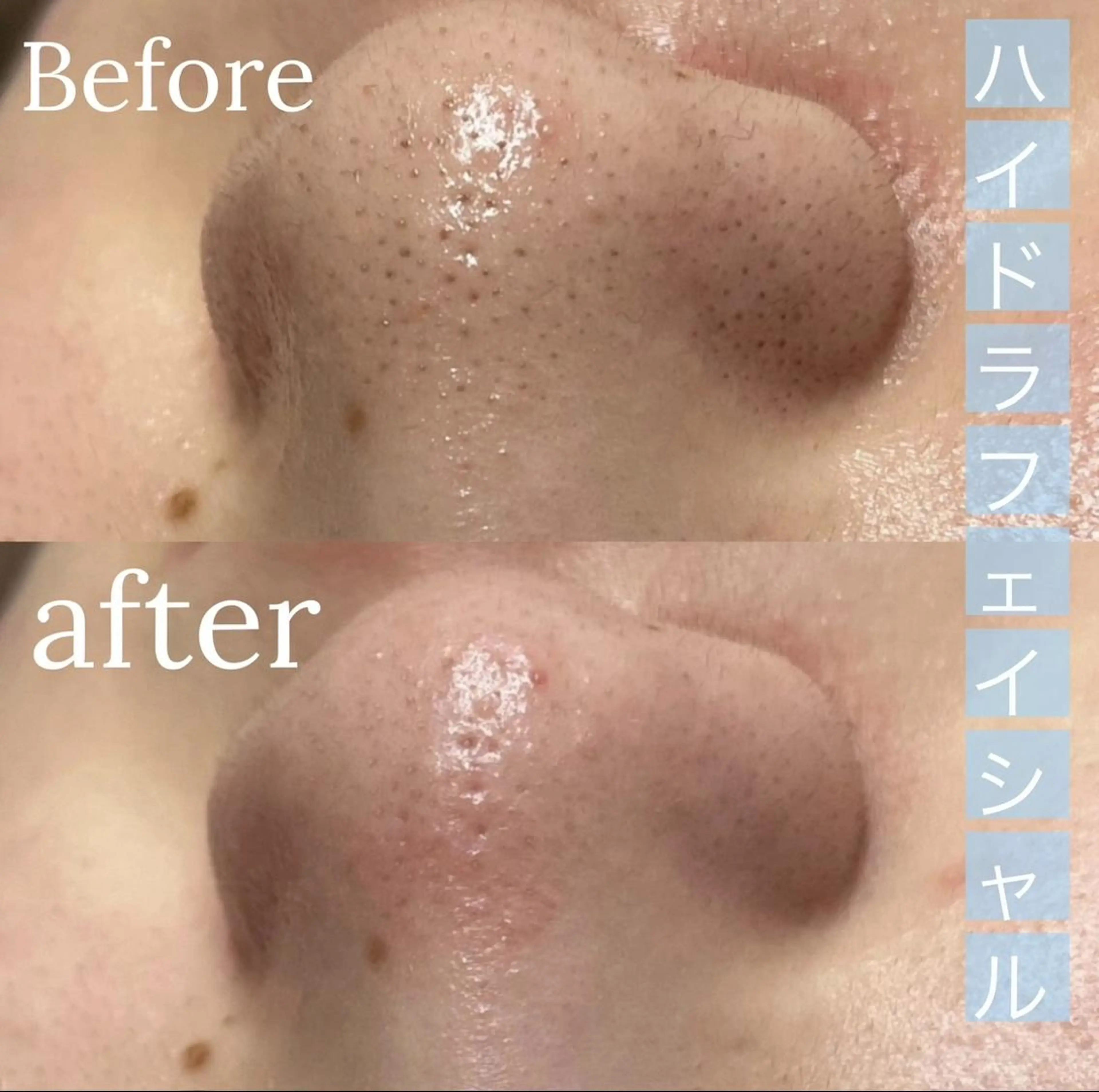 【角質・黒ずみ改善】毛穴洗浄(全顔)🚹🚺の写真