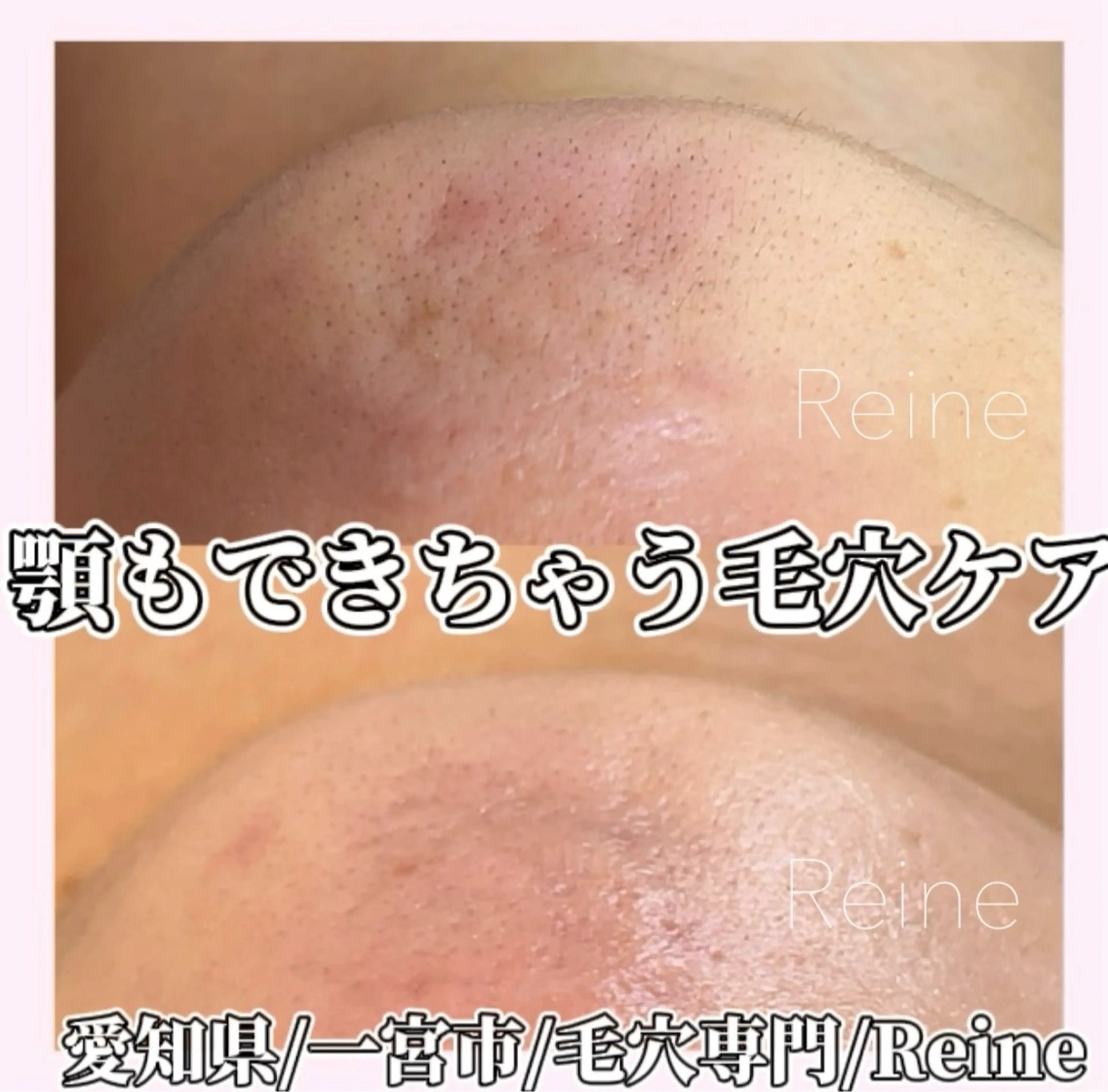 エステ Reine BeautySalon所属・毛穴/シミ肝斑/脱毛 横山梨里のエステ・リラクイメージ